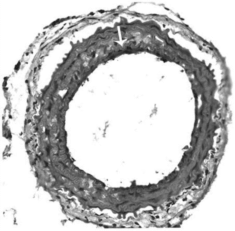 Drug coating stent based on HIV protease inhibitor saquinavir as well as preparation method and application thereof