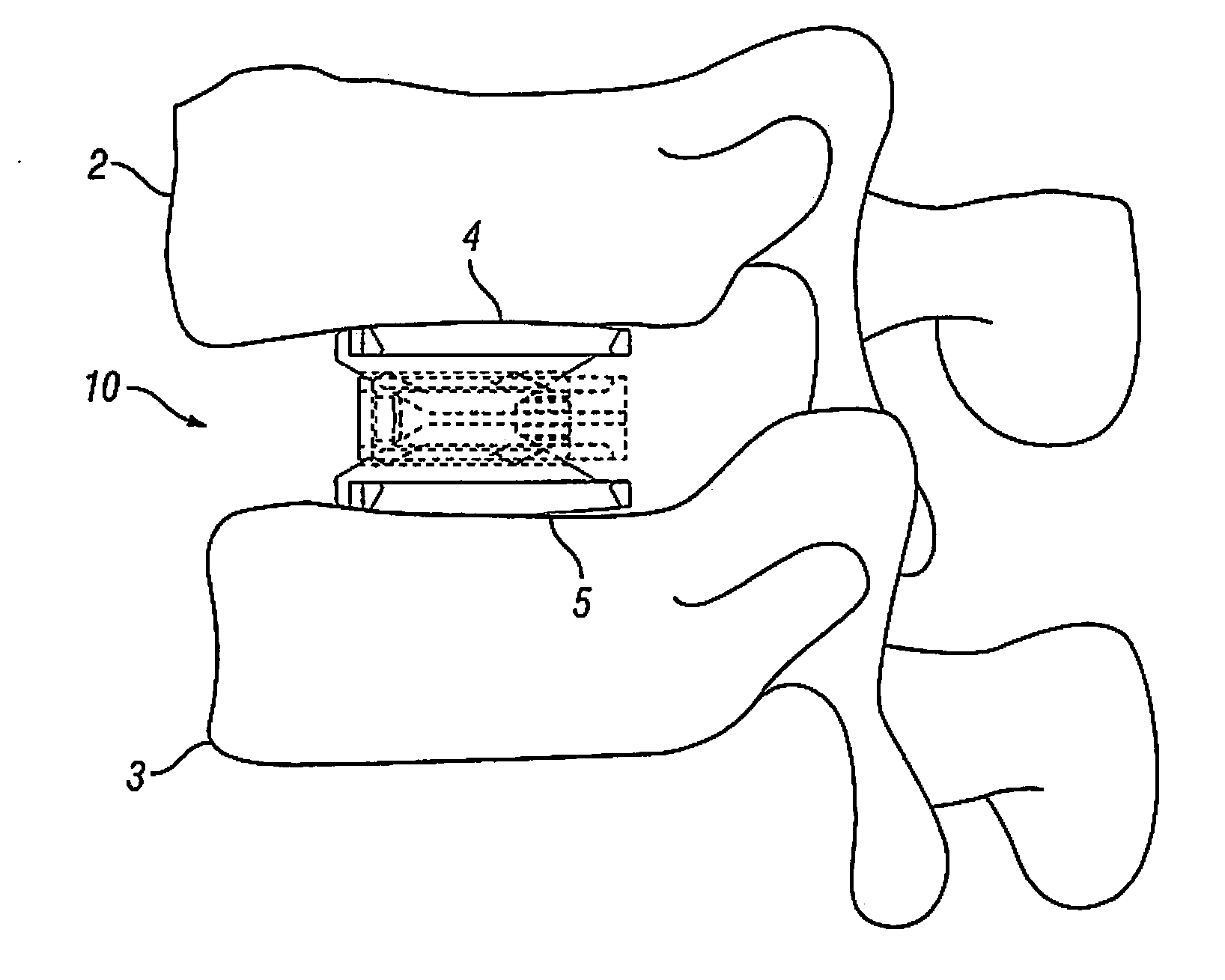 Expandable Fusion Device and Method of Installation Thereof