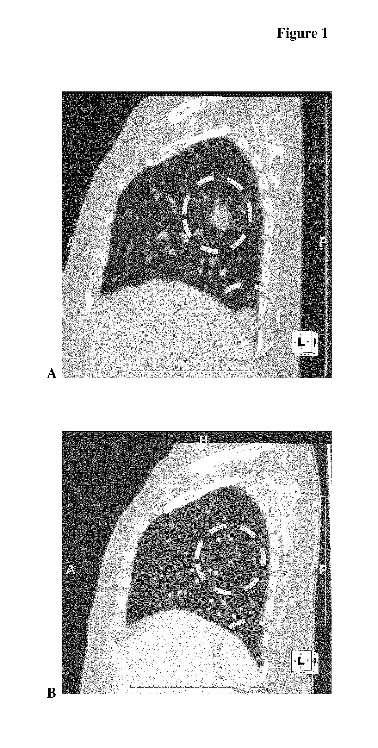 Syd985 treatment of t-dm1 refractory cancer patients