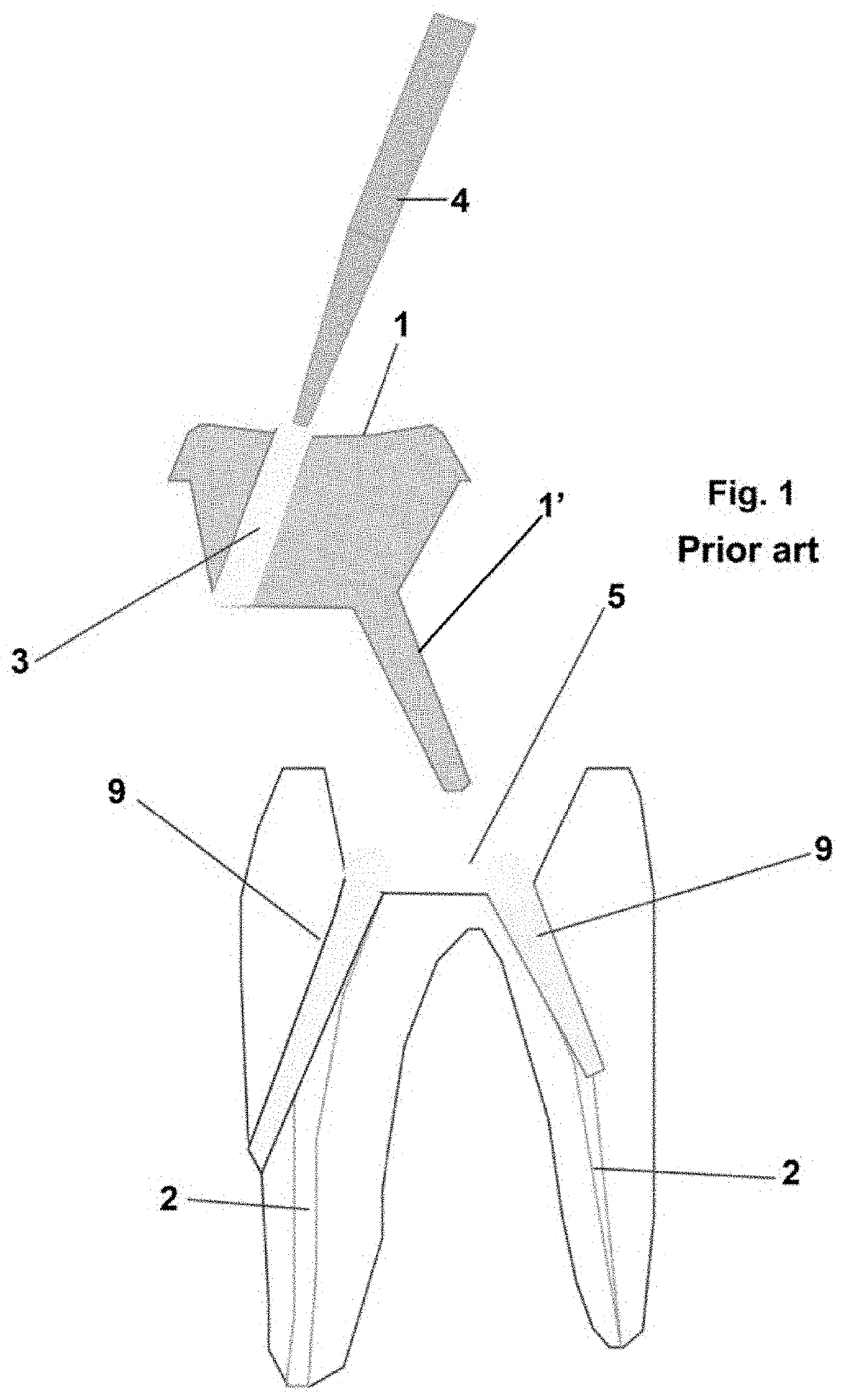 Crown and root dental restoration, method for performing one such restoration and method for etching one such dental restoration