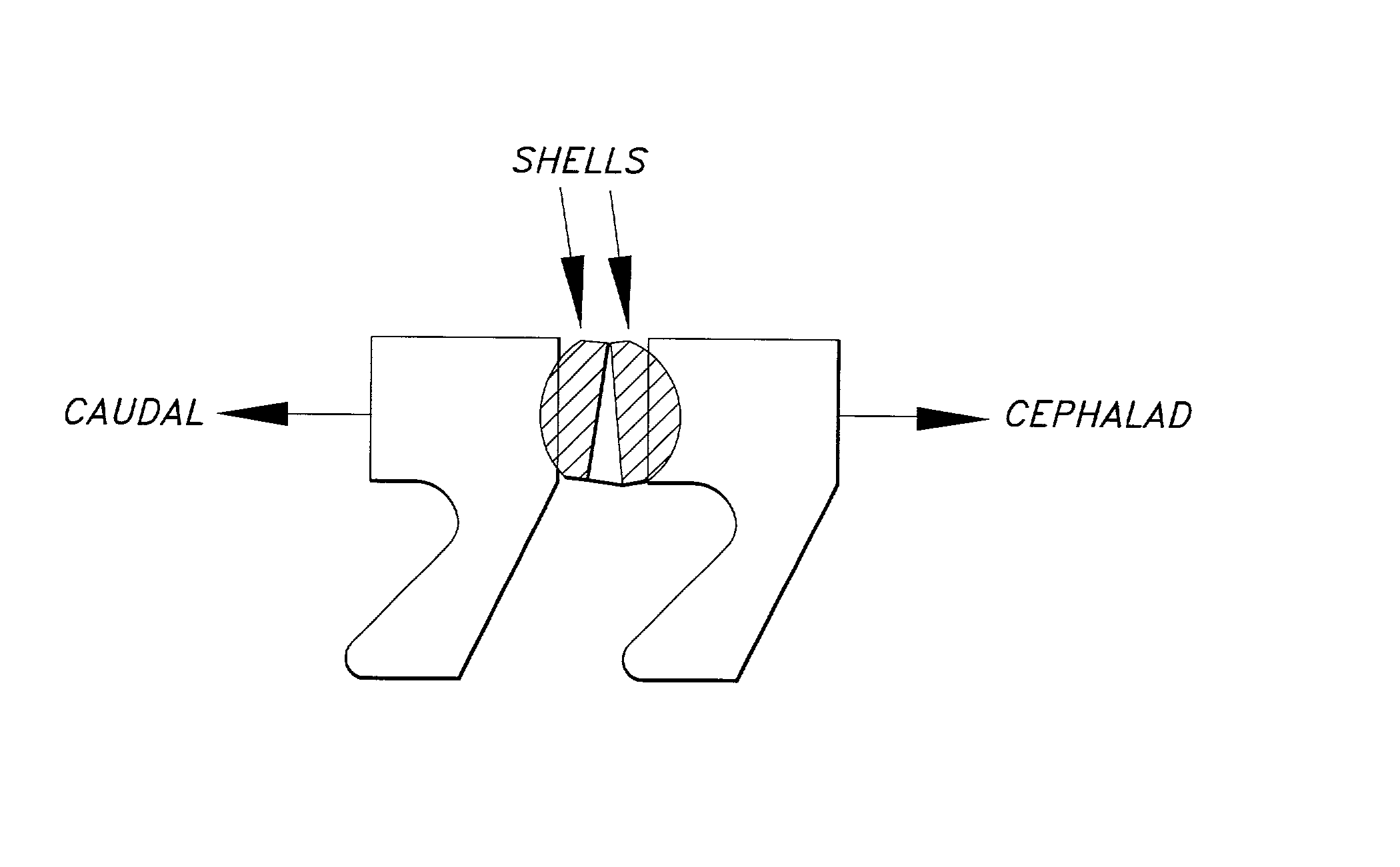 Method and apparatus for stereotactic impleantation