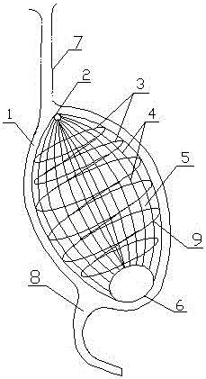 Volume-reducing stomach stent