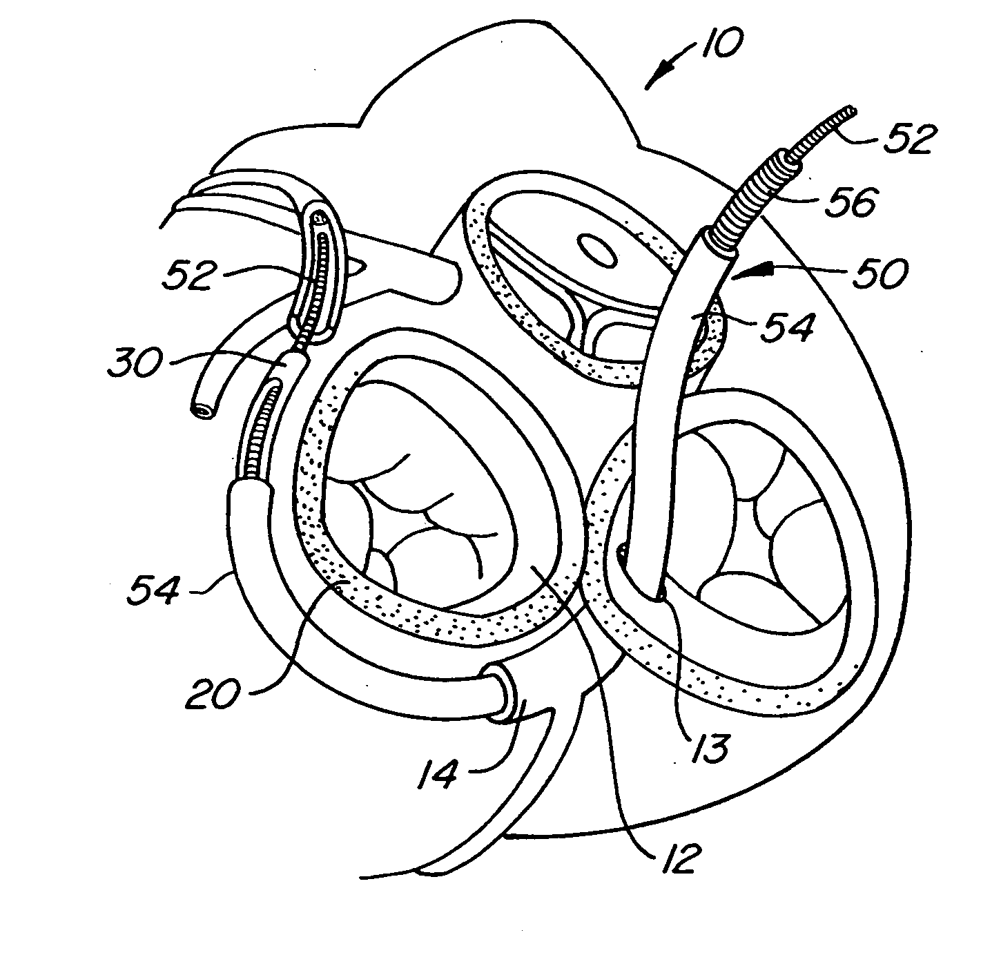 Mitral valve therapy device, system and method