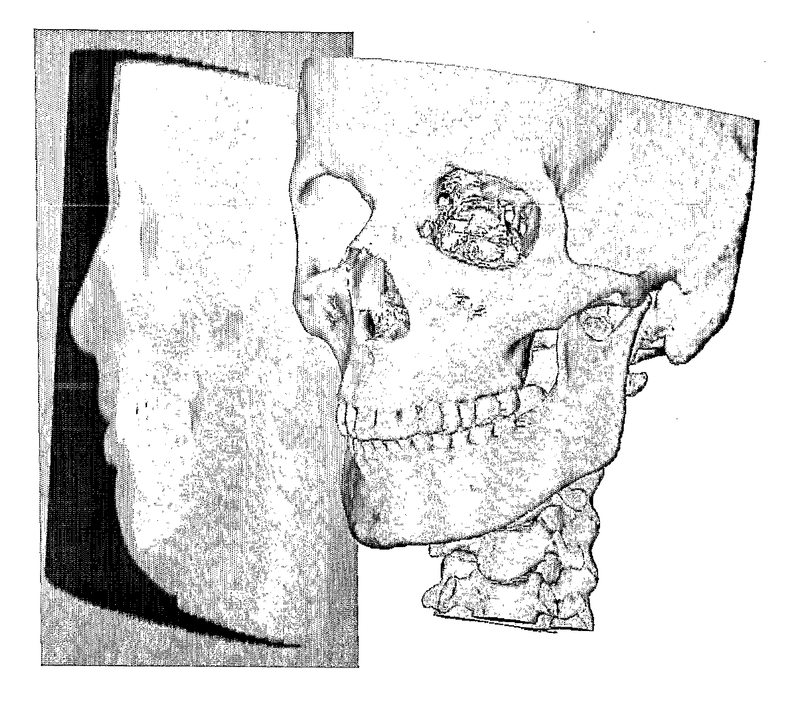 Method for deriving a treatment plan for orthognatic surgery and devices therefor