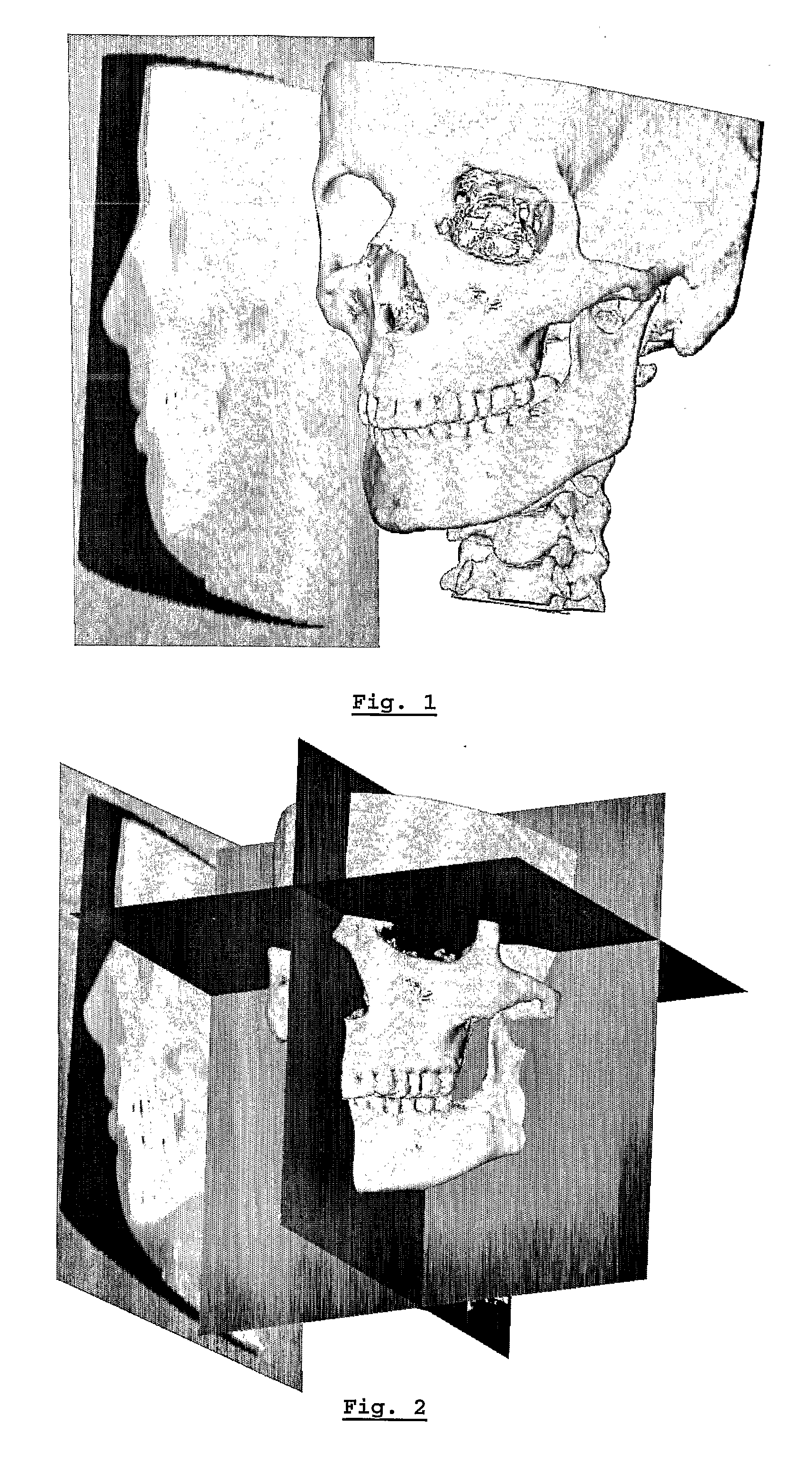 Method for deriving a treatment plan for orthognatic surgery and devices therefor