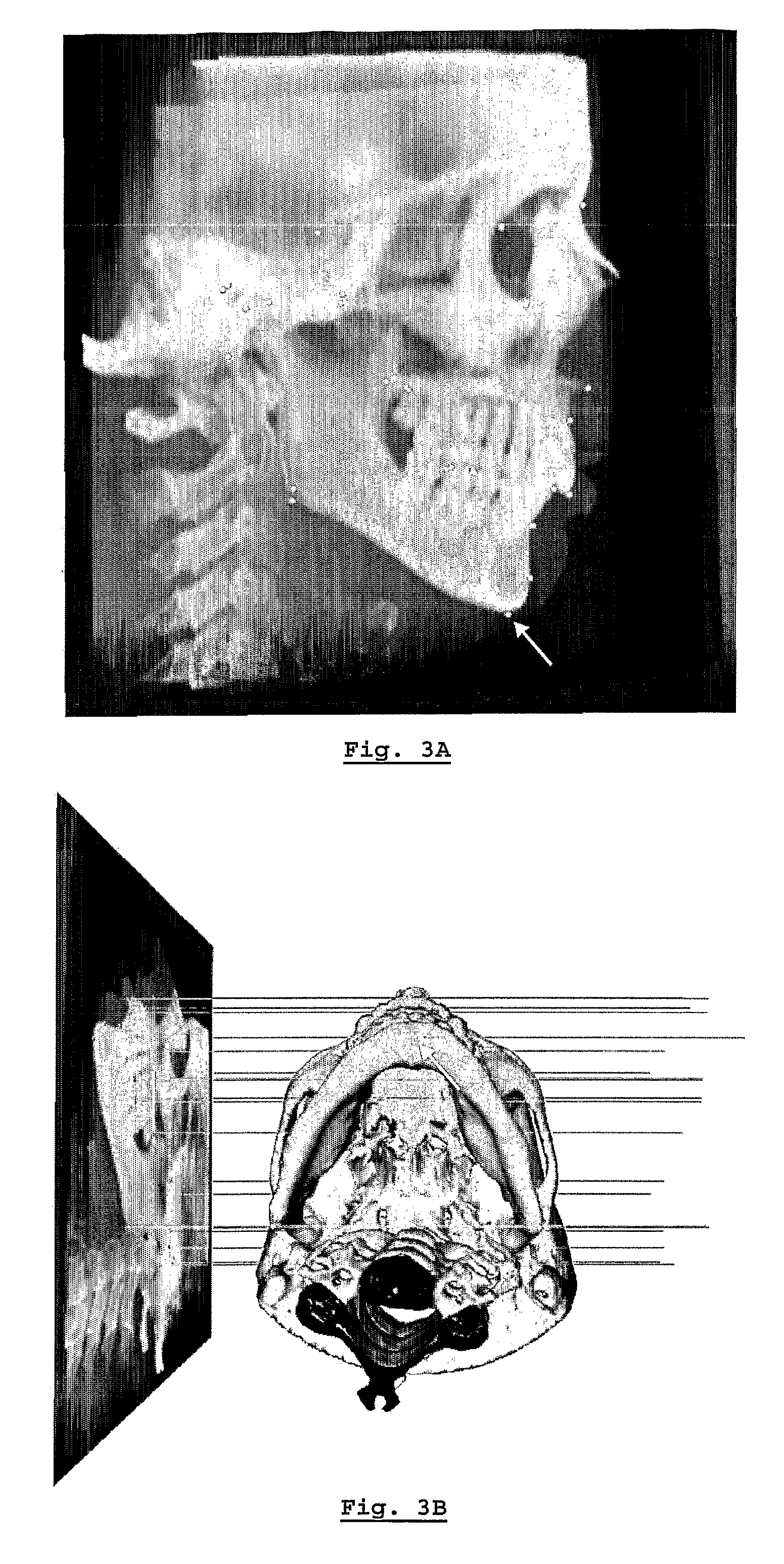 Method for deriving a treatment plan for orthognatic surgery and devices therefor