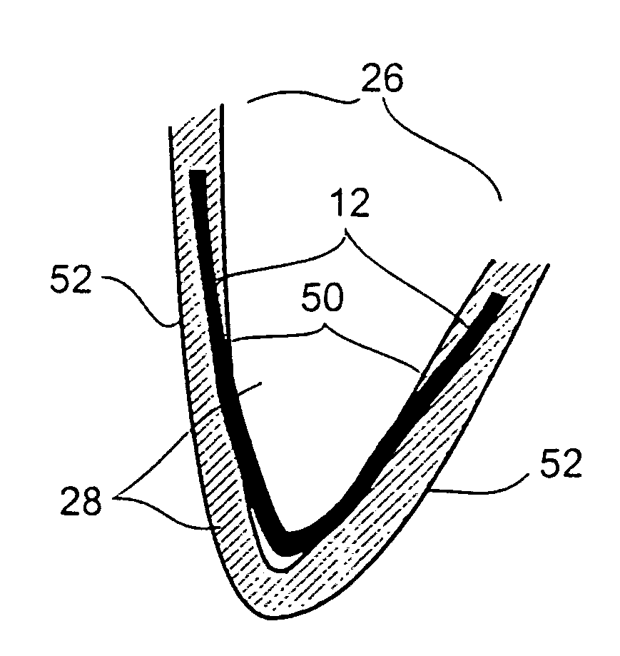 In-vivo method and device for improving diastolic function of the left ventricle