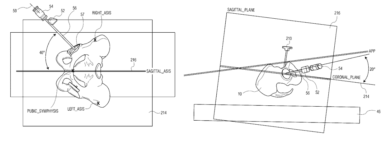 Method for aligning an acetabular cup