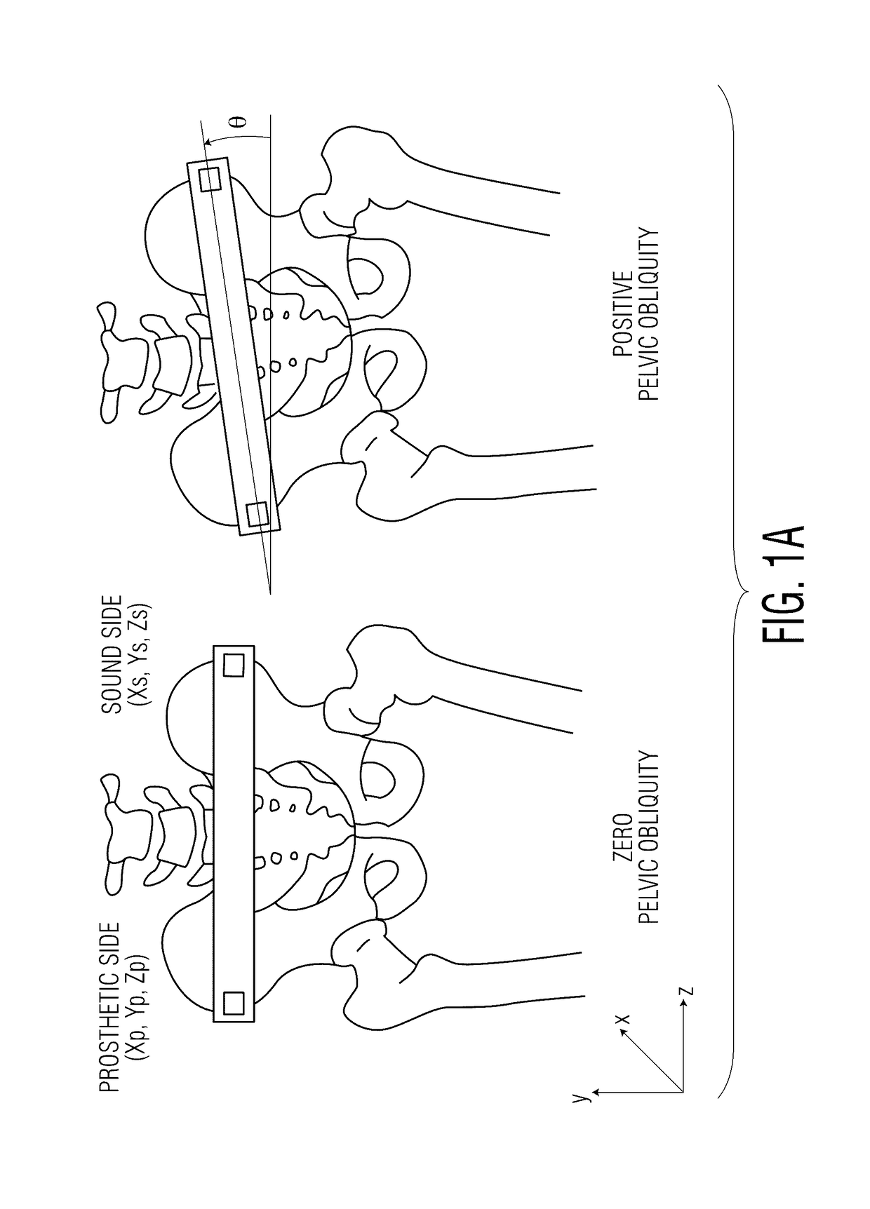 Method for aligning an acetabular cup