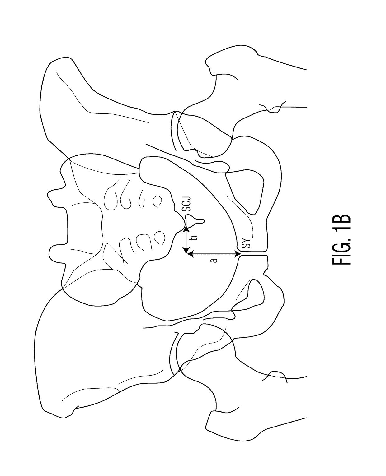 Method for aligning an acetabular cup