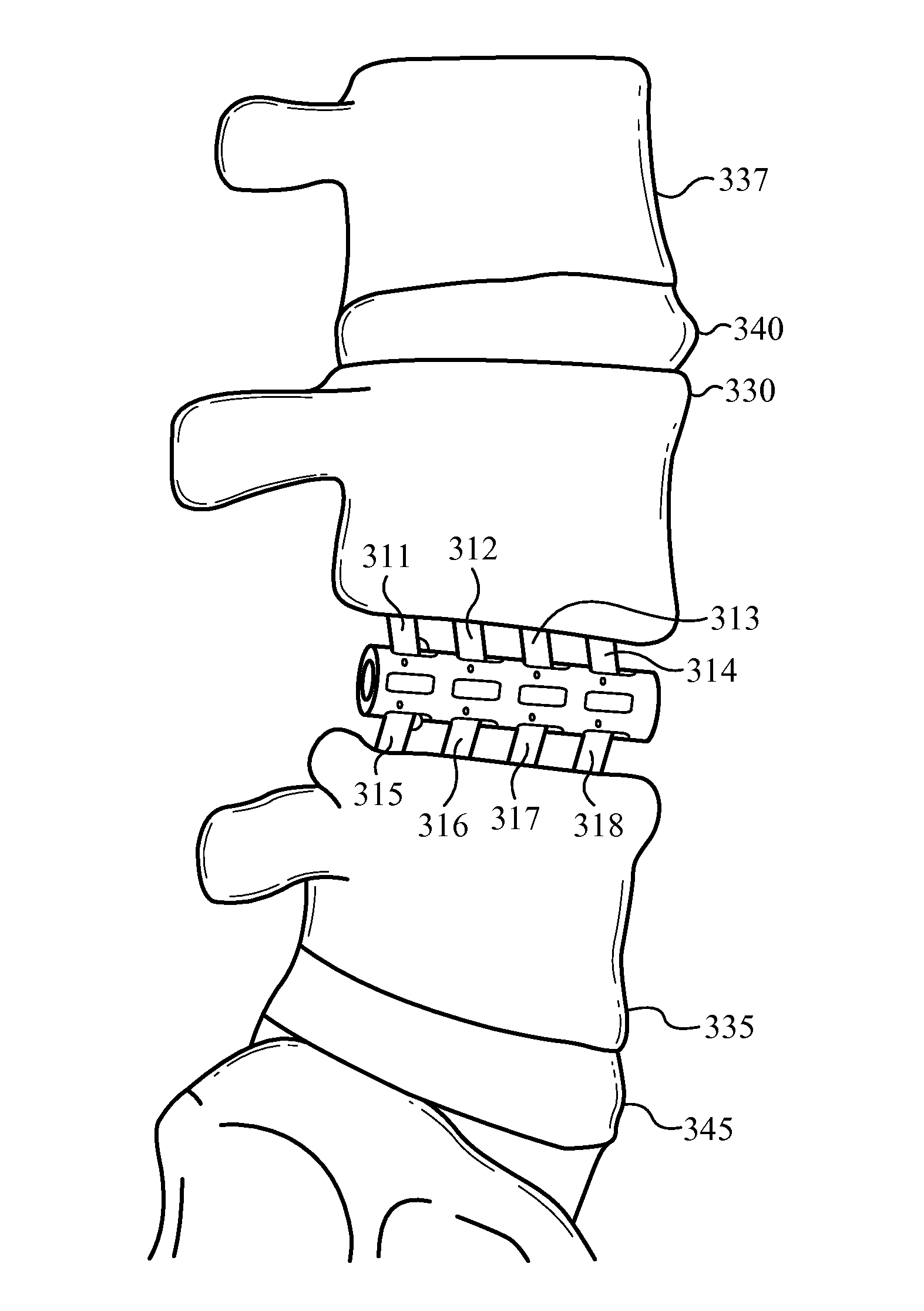 Bone fusion device