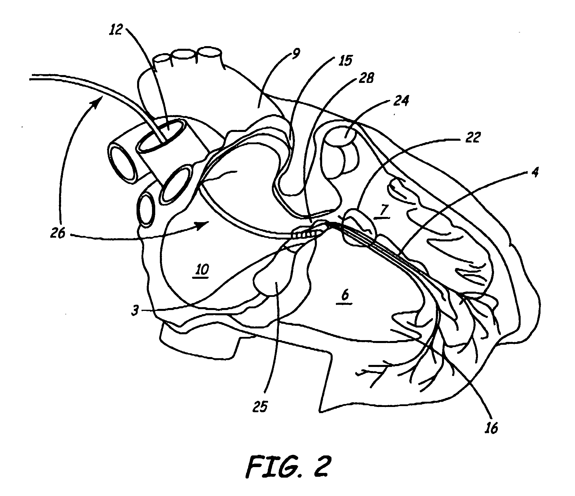 Pacing method