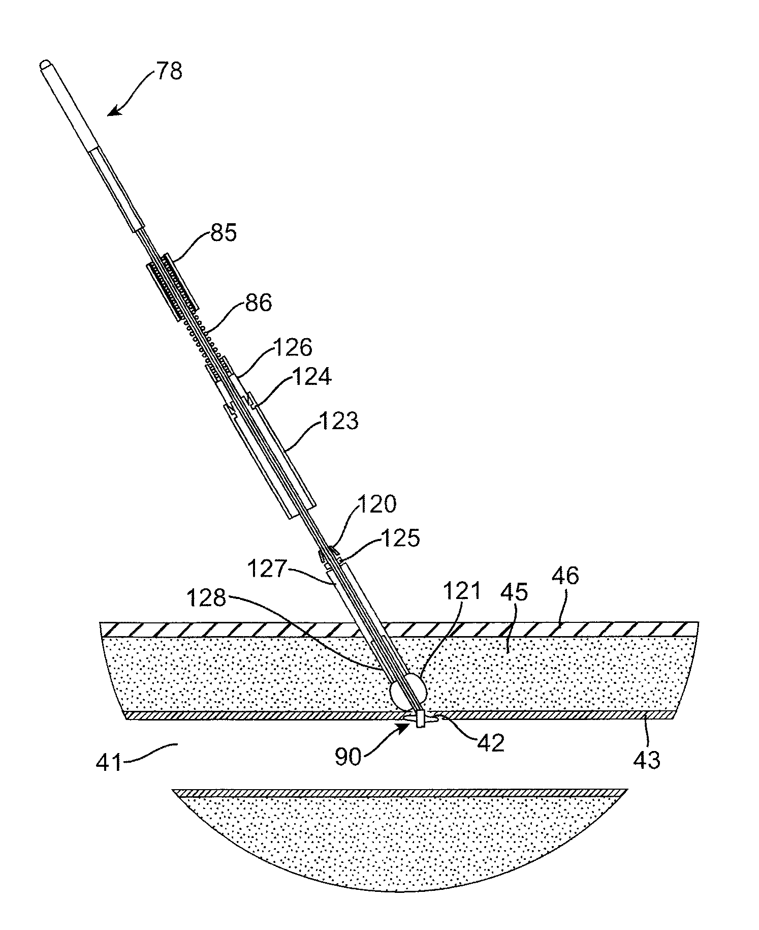 Catheter with sealed hydratable hemostatic occlusion element