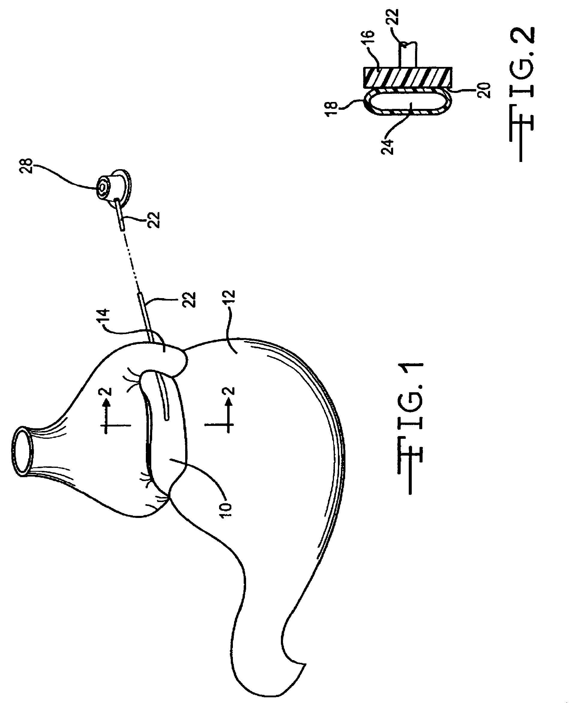 Implantable band with attachment mechanism having dissimilar material properties