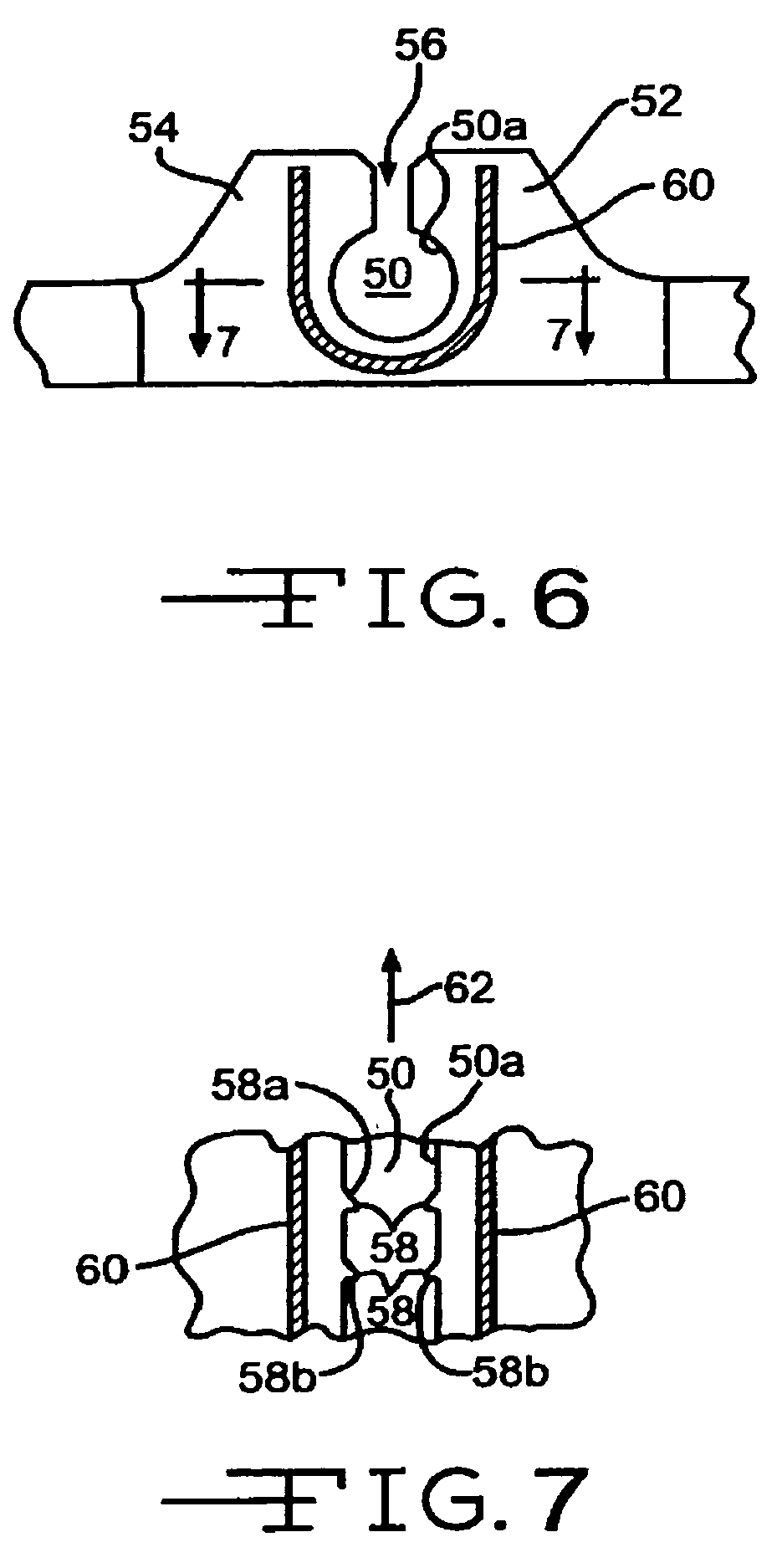 Implantable band with attachment mechanism having dissimilar material properties