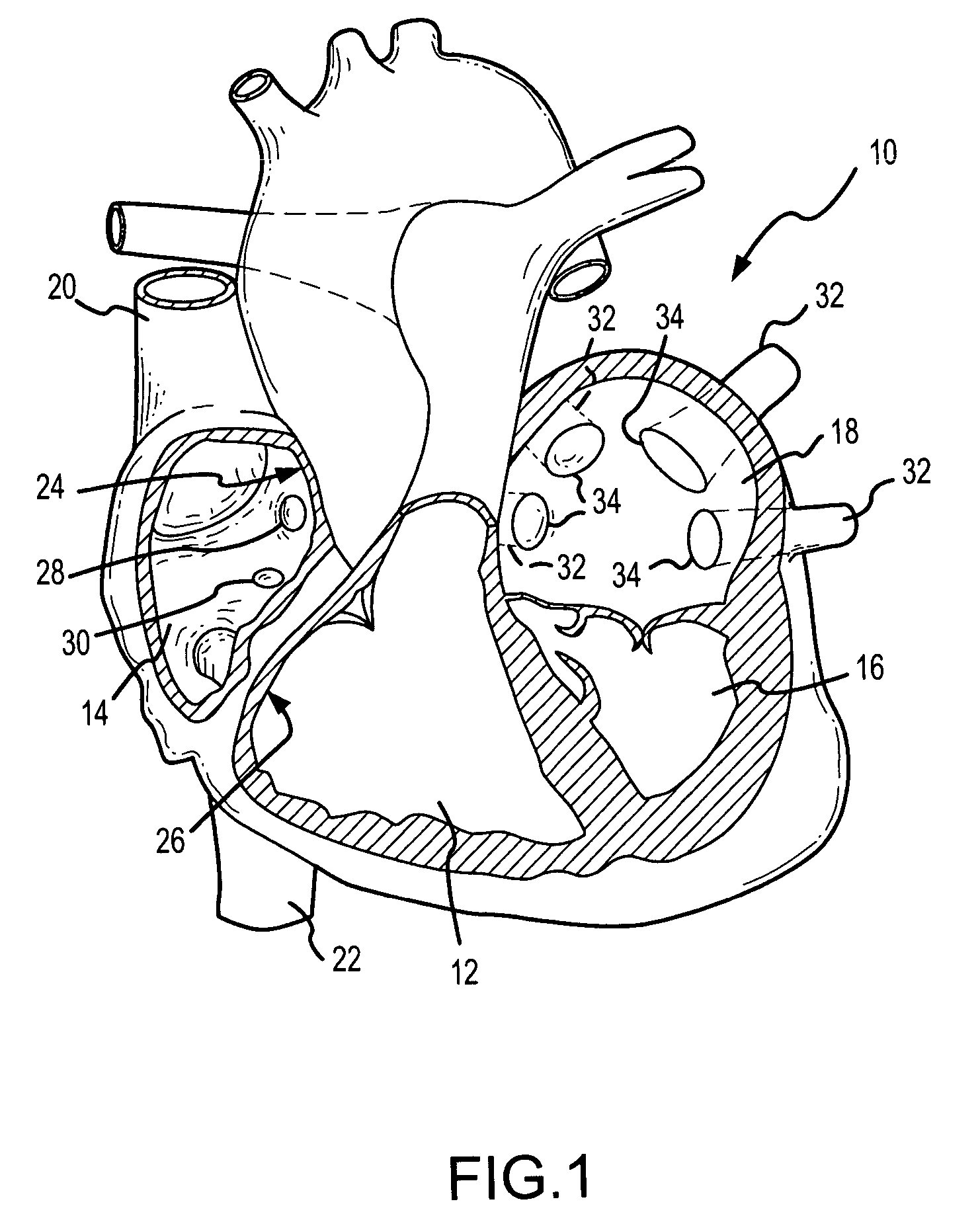 Ablation fluid manifold for ablation catheter