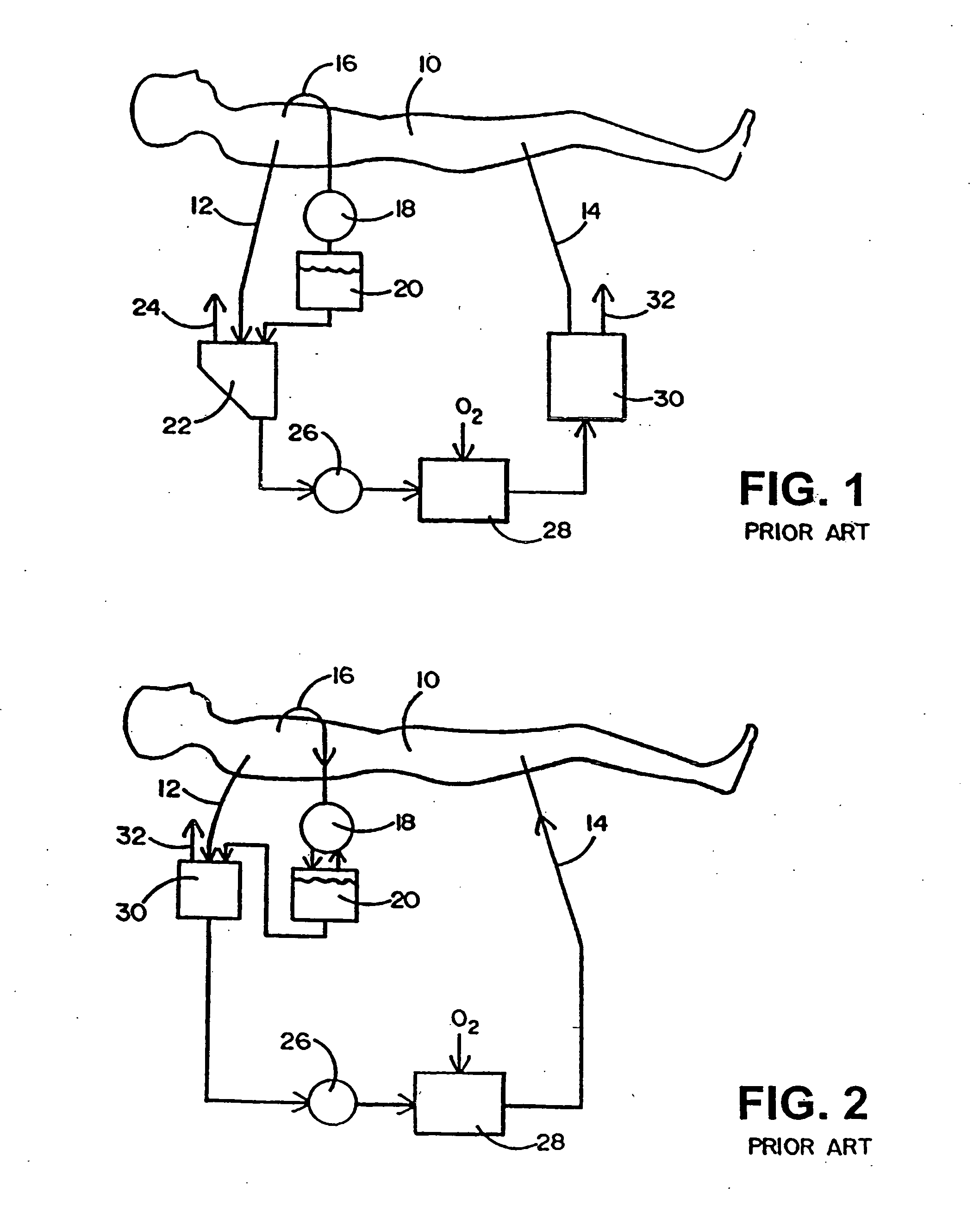 Cardiopulmonary bypass extracorporeal blood circuit apparatus and method