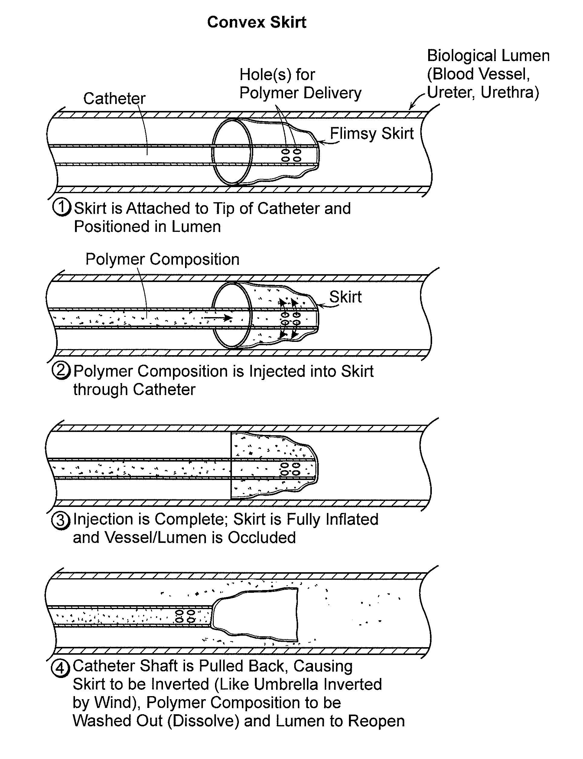 Atraumatic occlusion balloons and skirts, and methods of use thereof