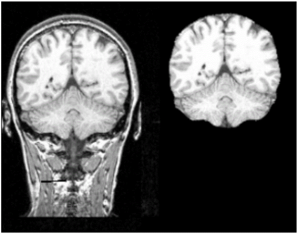 FMRI and DTI fusion-based vault white matter segmentation method