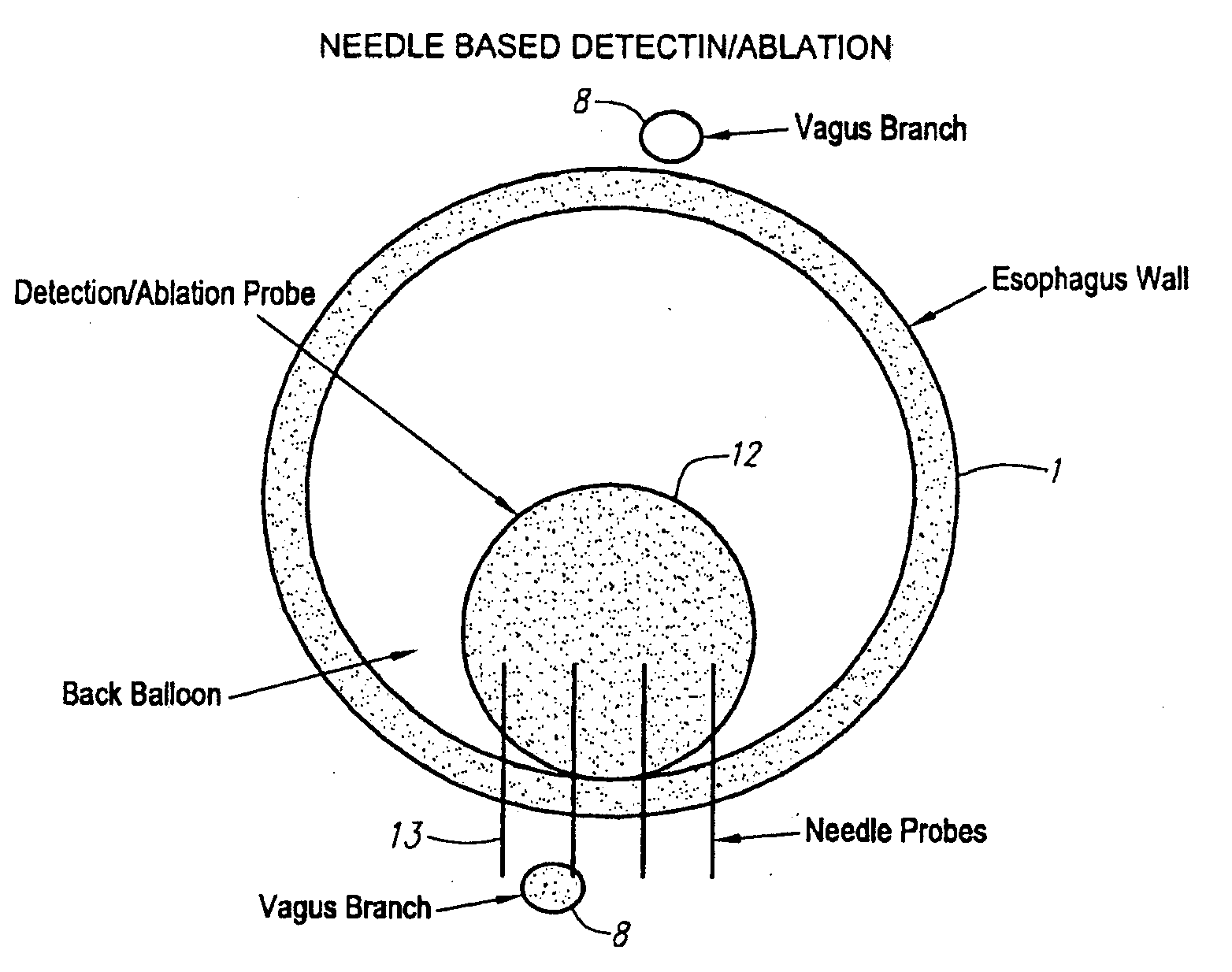 Methods and apparatus for treatment of obesity