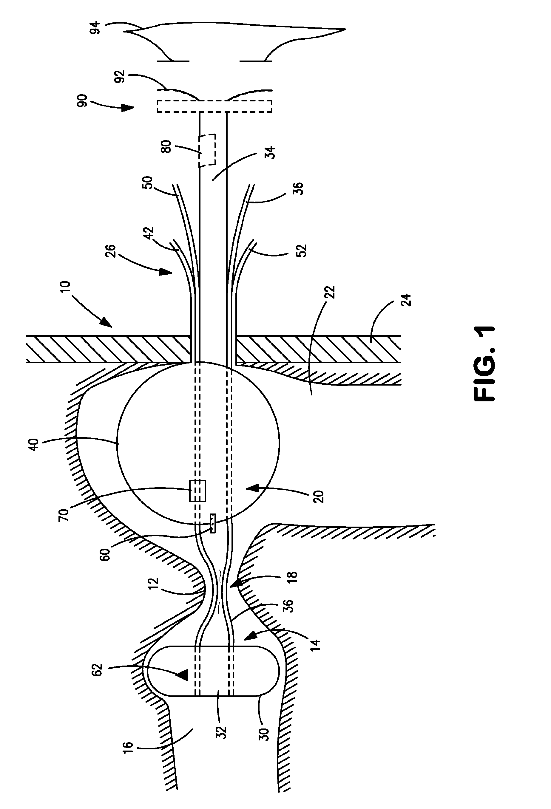 Temporary ostomy appliance