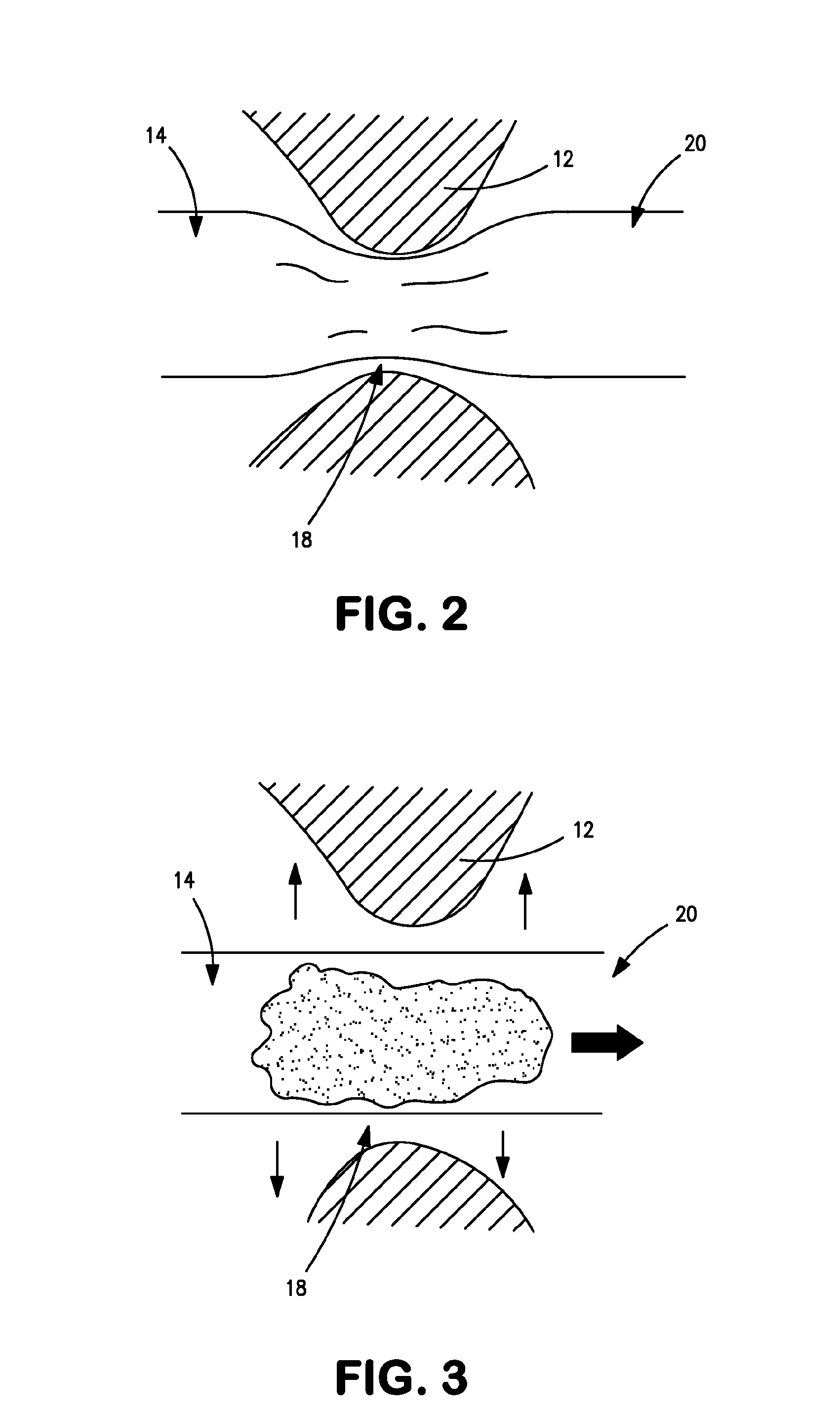 Temporary ostomy appliance