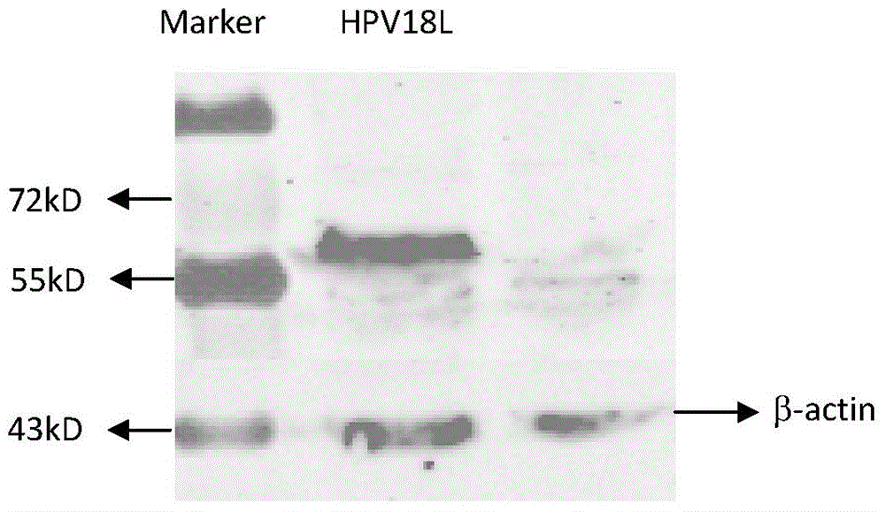 HPV16, 18L1 recombinant DNA vaccine for preventing and treating esophagus cancers