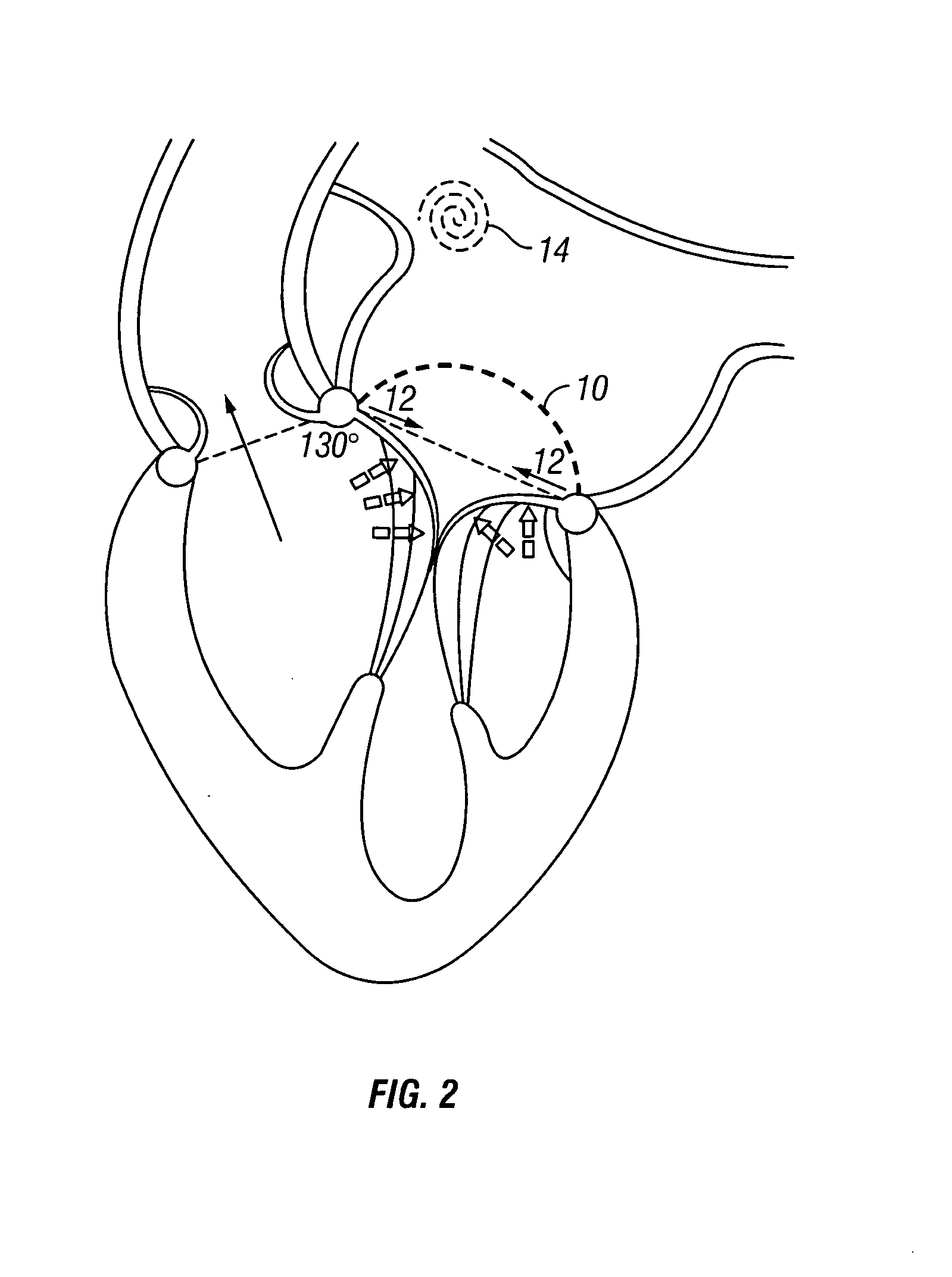 Methods and apparatus for mitral valve repair