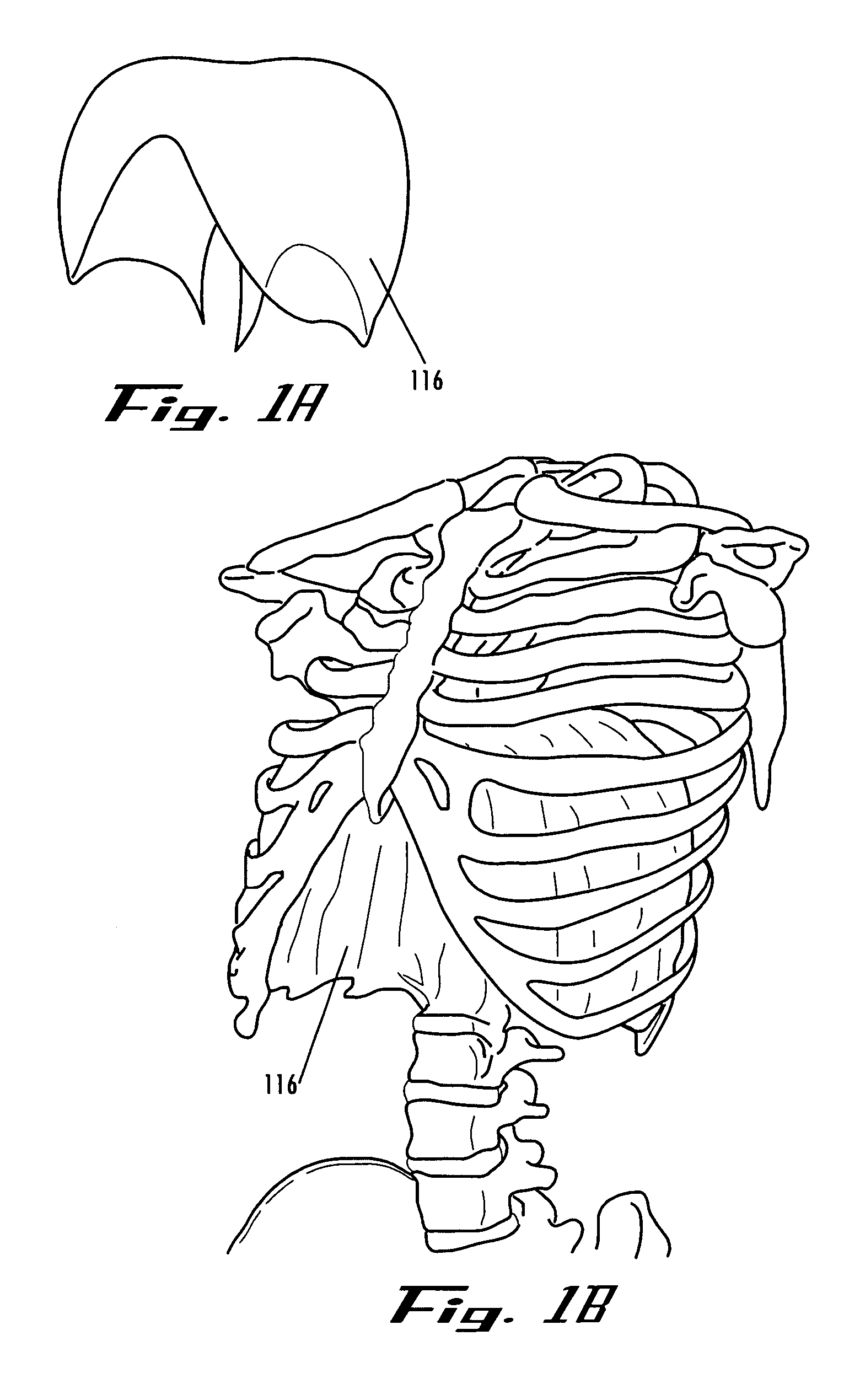 Devices and methods for treatment of obesity