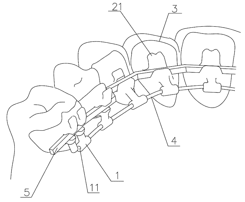 Personalized orthodontic appliance having orthoaxis function