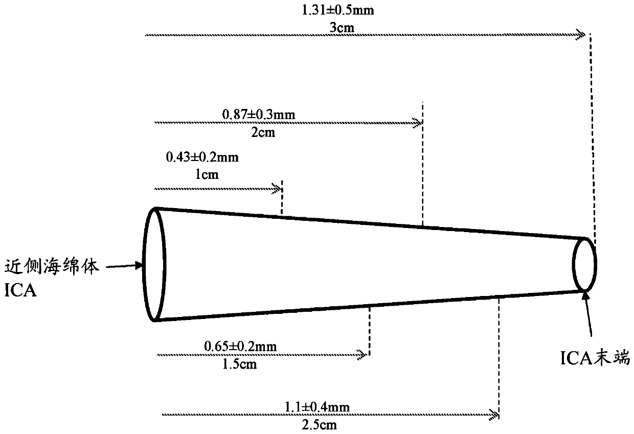 Systems and methods of using a braided implant