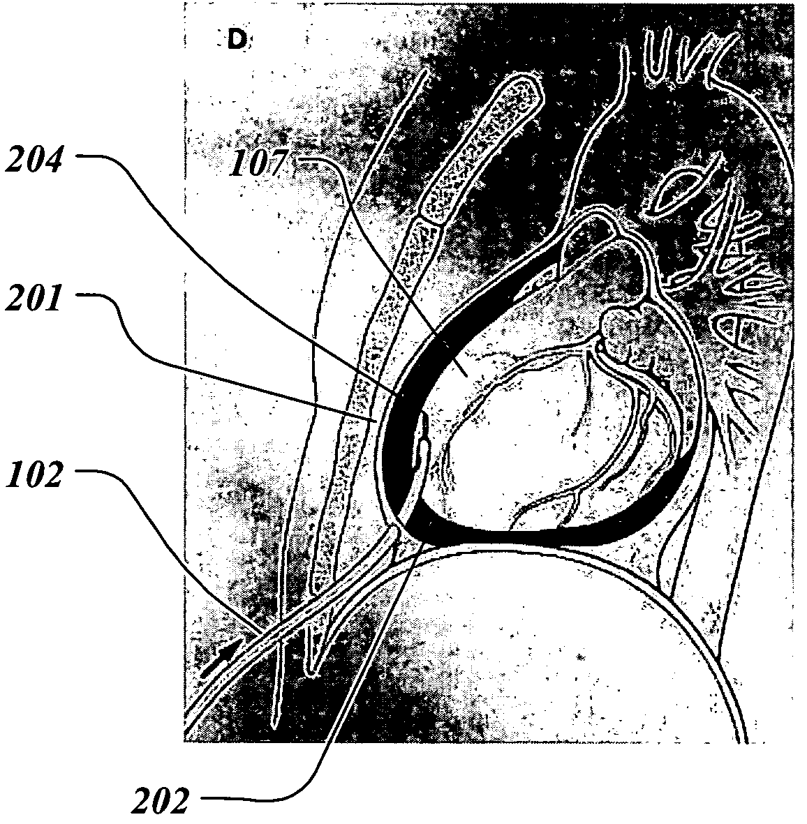 Method and system to treat and prevent myocardial infarct expansion