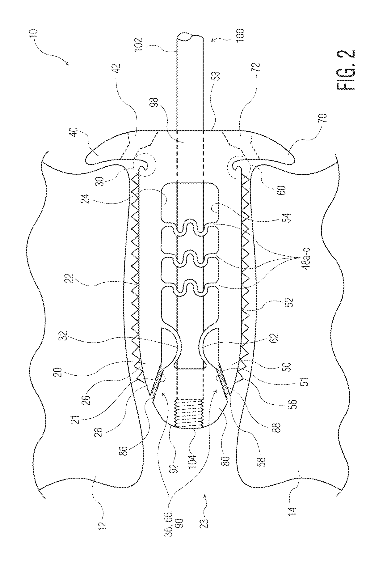 Expandable implant