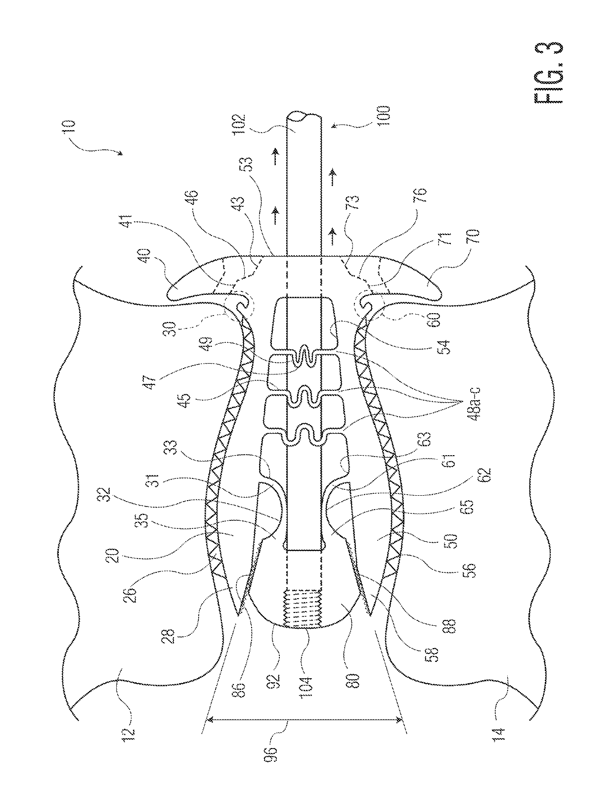 Expandable implant