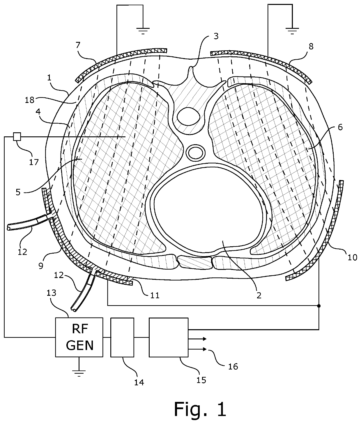 System for treating unwanted tissue using heat and heat activated drugs