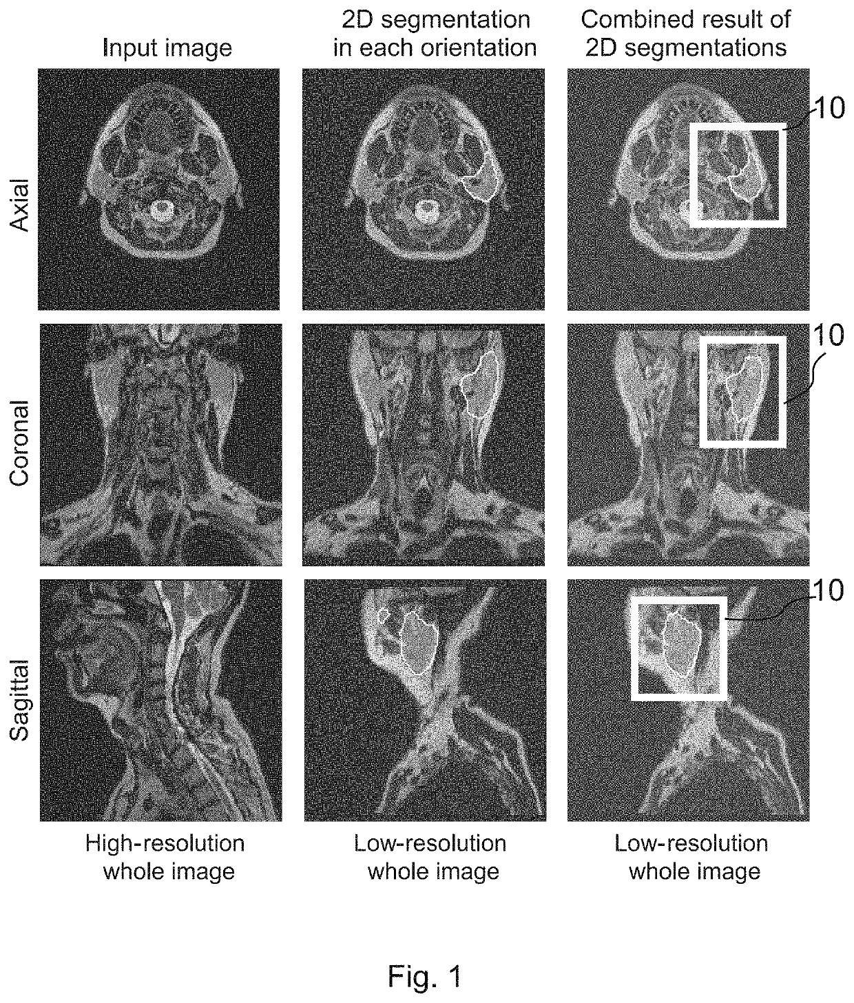 Method, system and computer readable medium for automatic segmentation of a 3D medical image