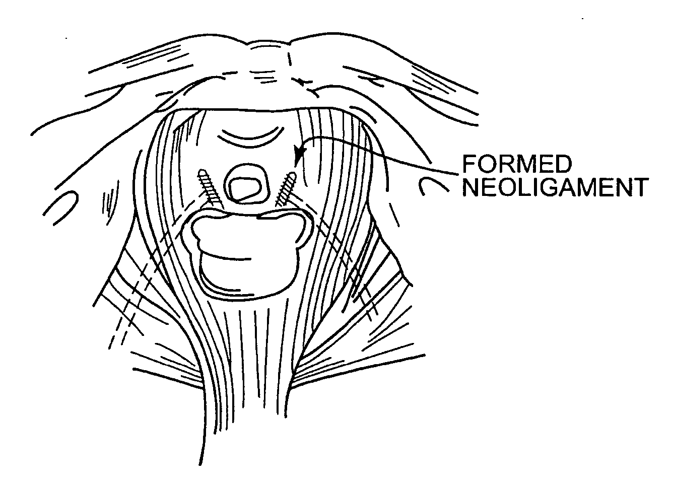 Method and articles for treatment of stress urinary incontinence