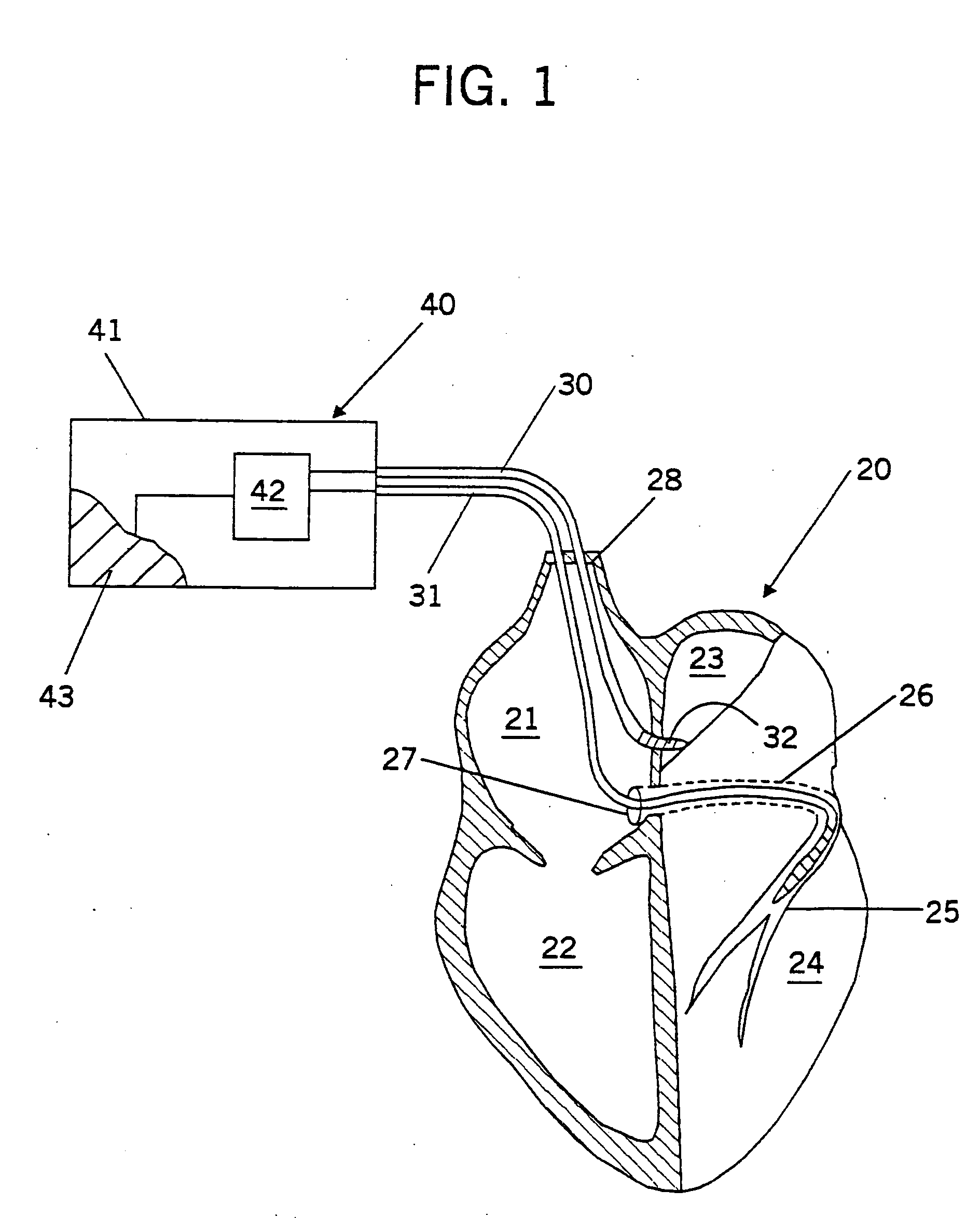 Bachmann's bundle electrode for atrial defibrillation