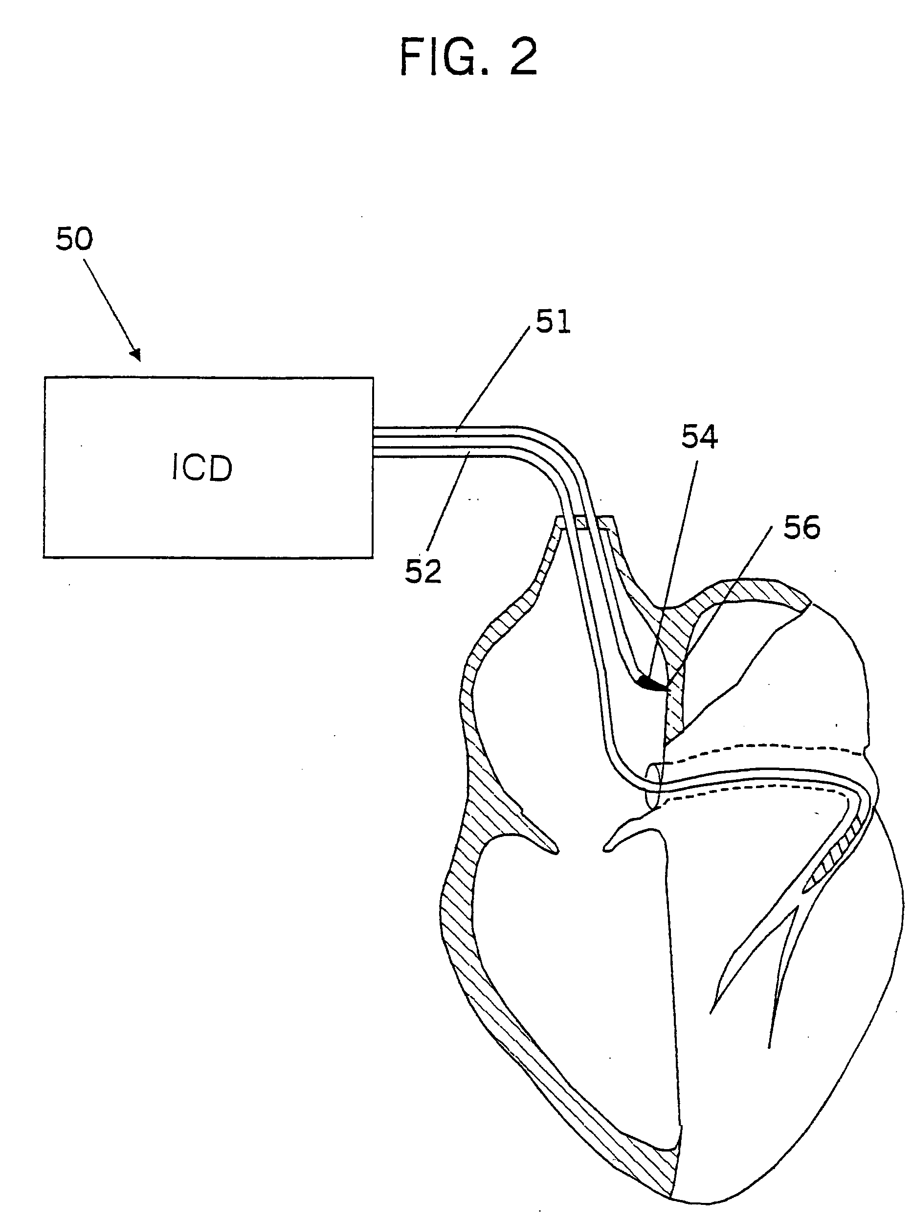 Bachmann's bundle electrode for atrial defibrillation