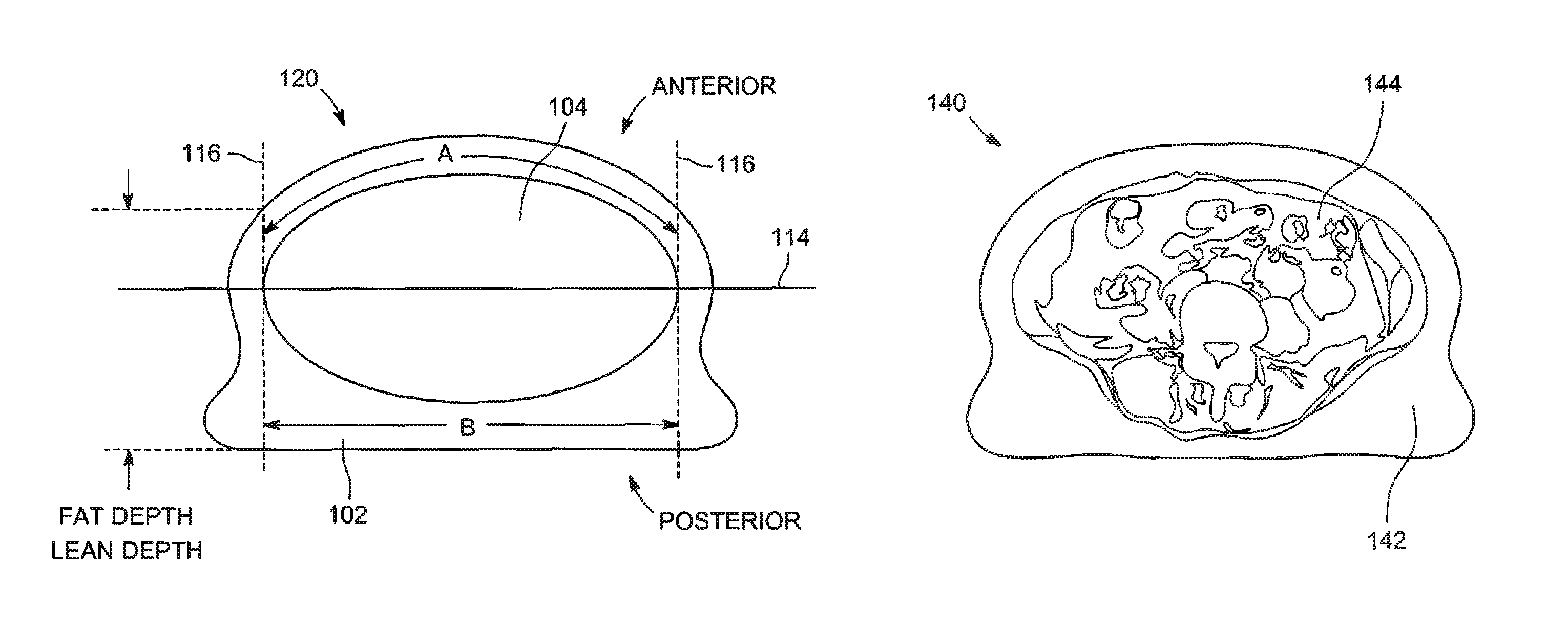 Method and system to estimate visceral adipose tissue by restricting subtraction of subcutaneous adipose tissue to coelom projection region