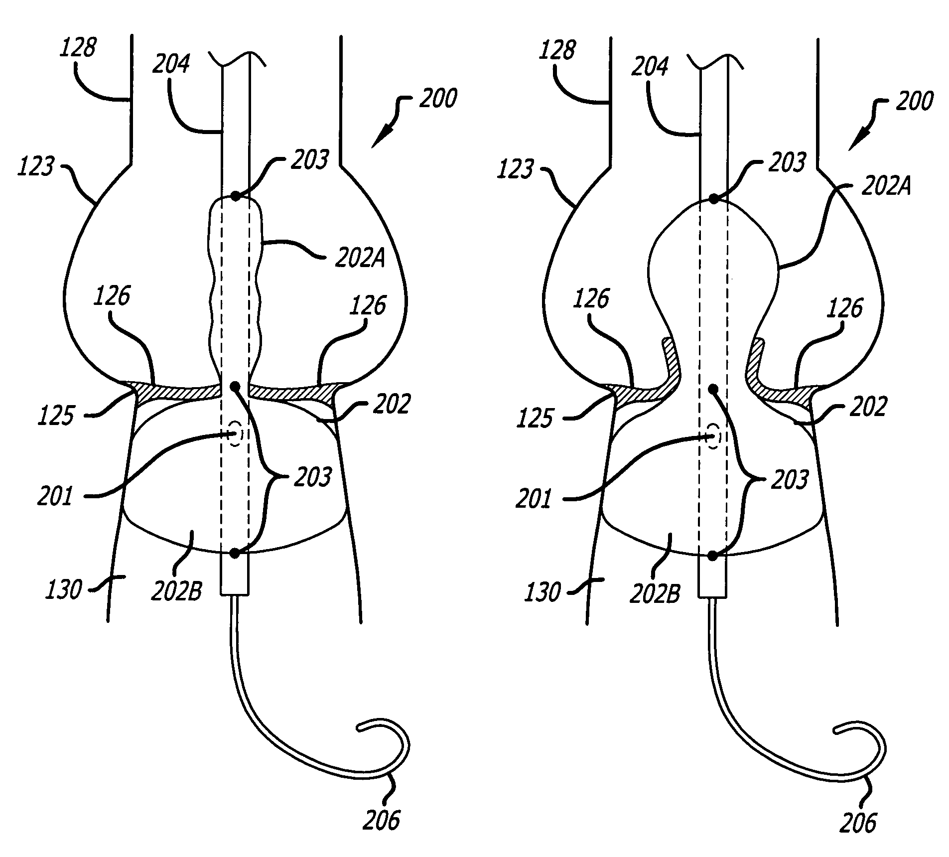 Valvuloplasty devices and methods