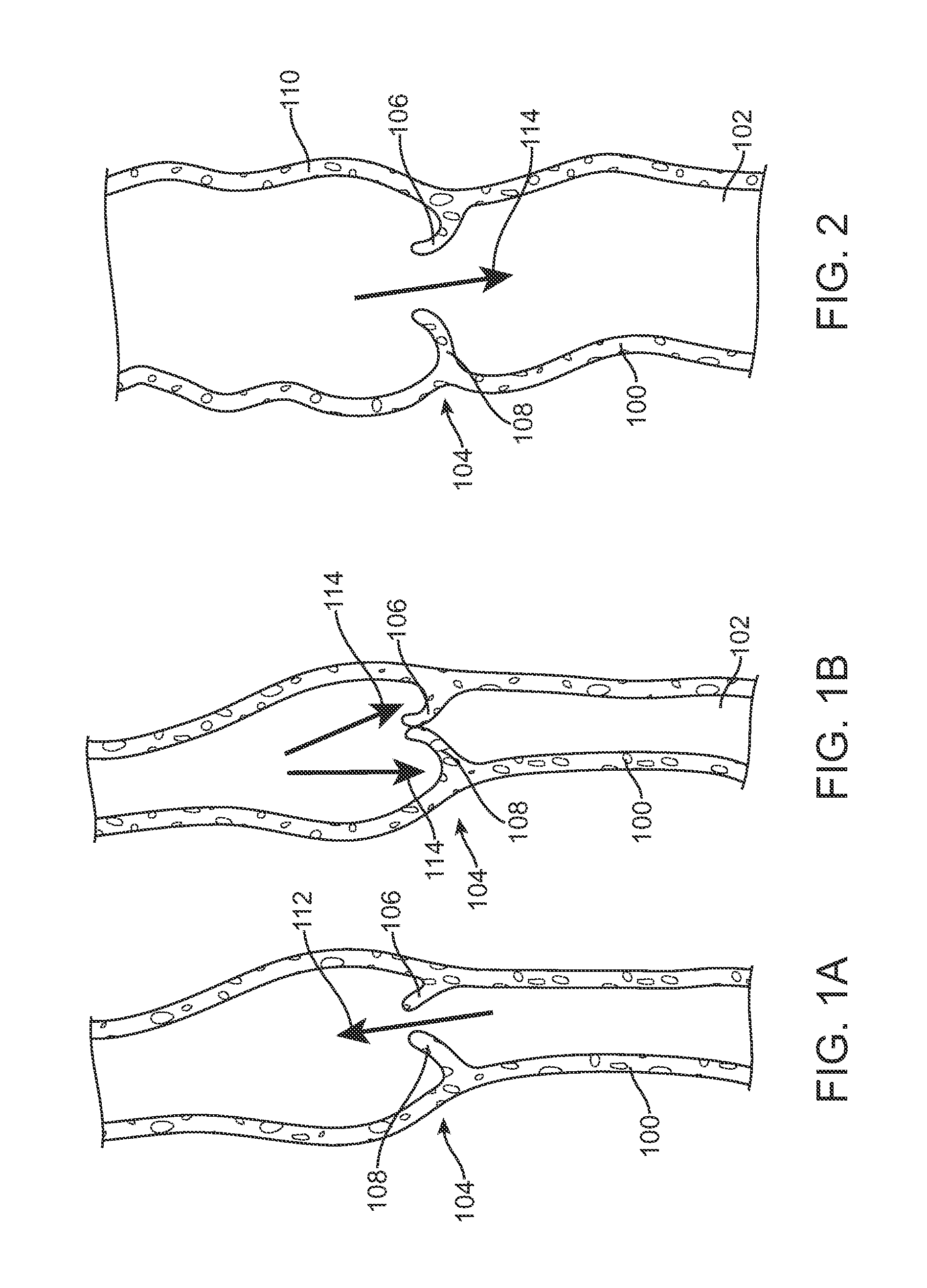 Percutanous Methods for Creating Native Tissue Venous Valves