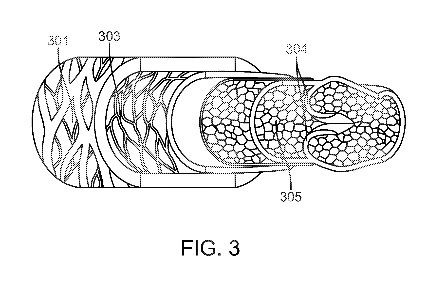 Percutanous Methods for Creating Native Tissue Venous Valves