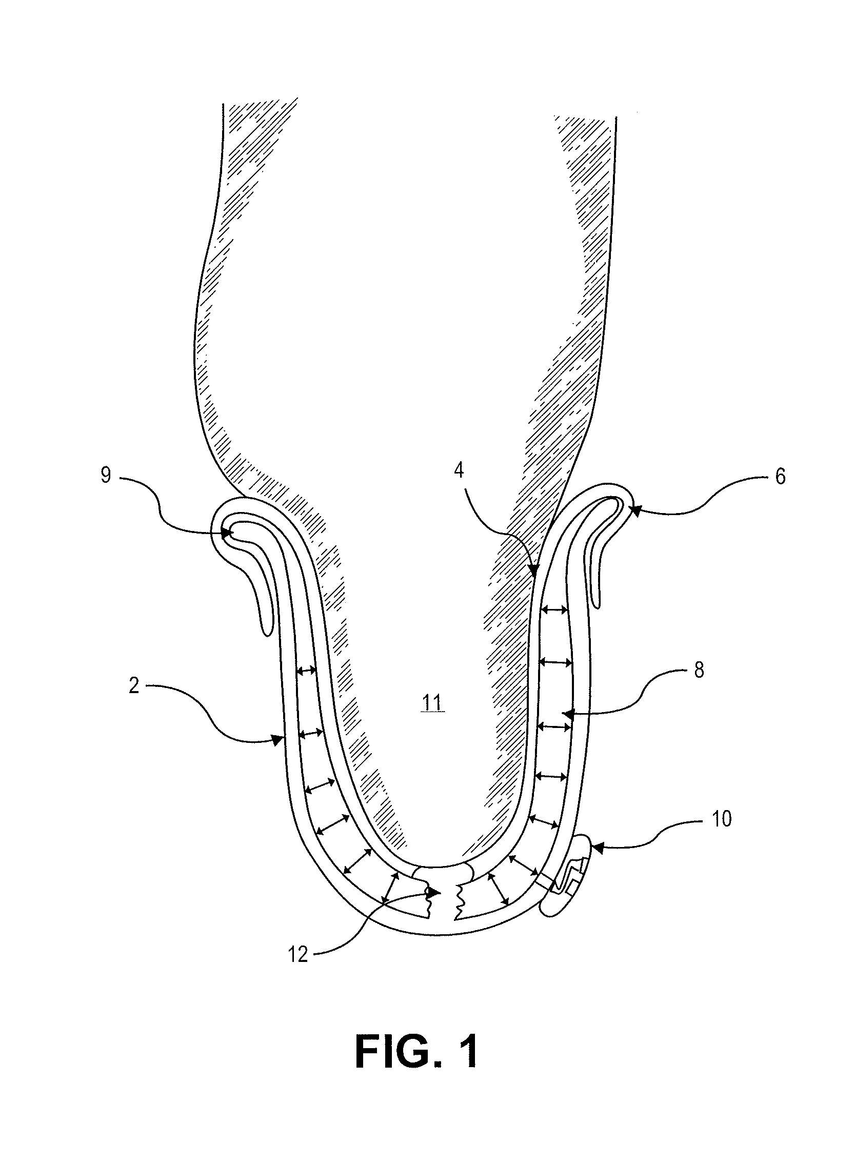 Adjustable prosthetic socket and suspension system