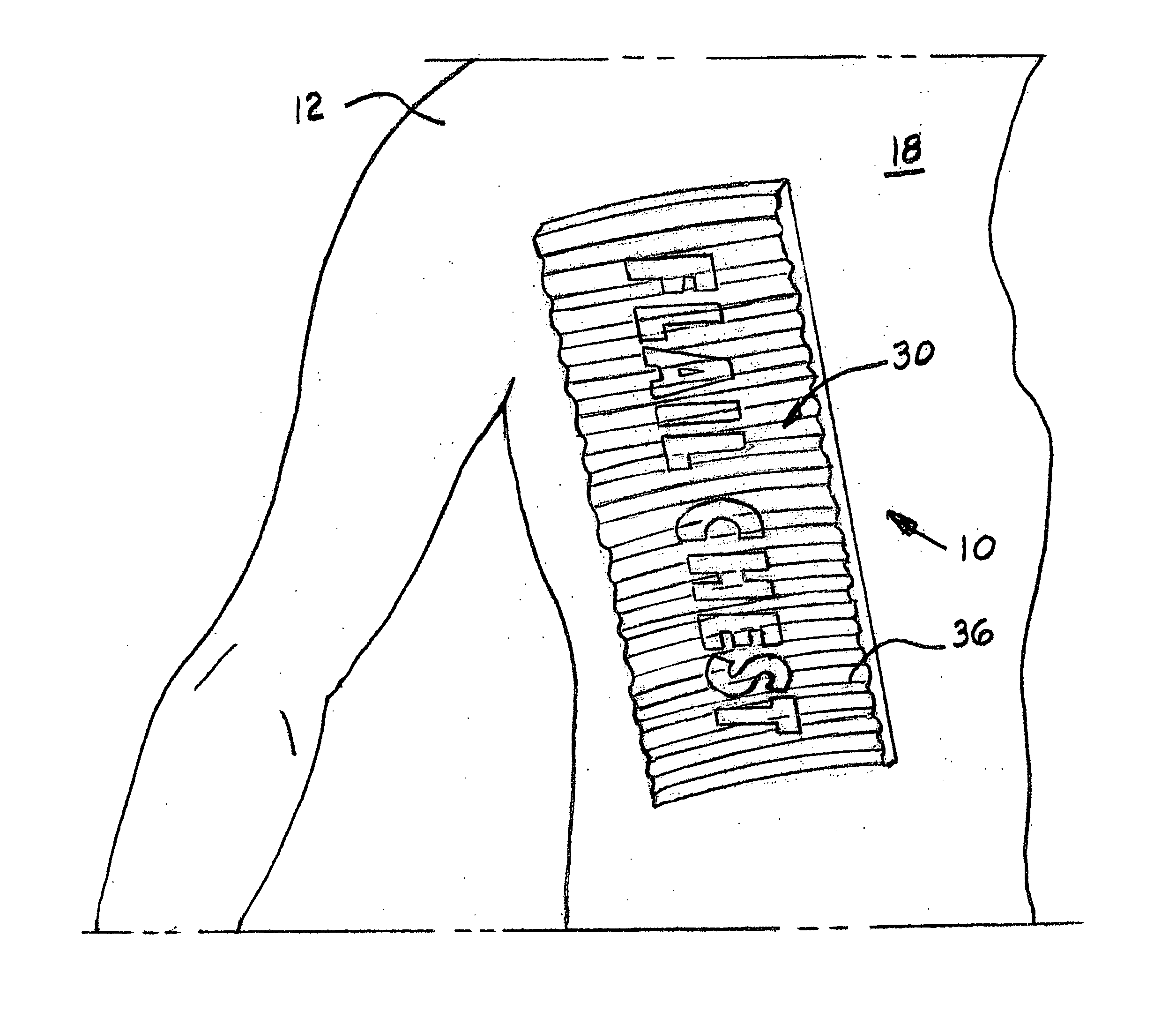 Medical device for temporarily treating flail chest injury