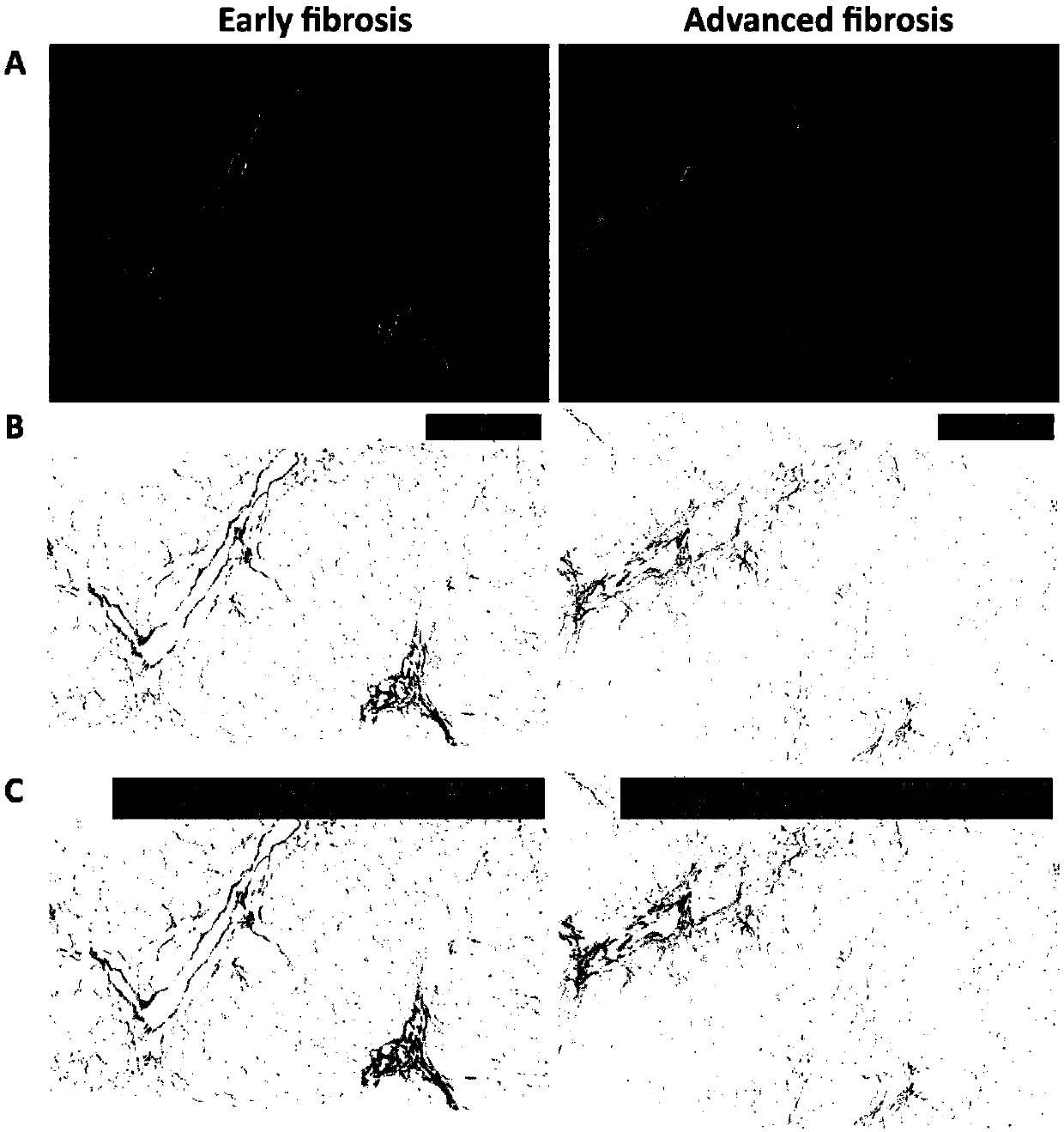 Application of parameters in SHG/TPEF images as hepatic fibrosis staging characteristic parameters of adults or children