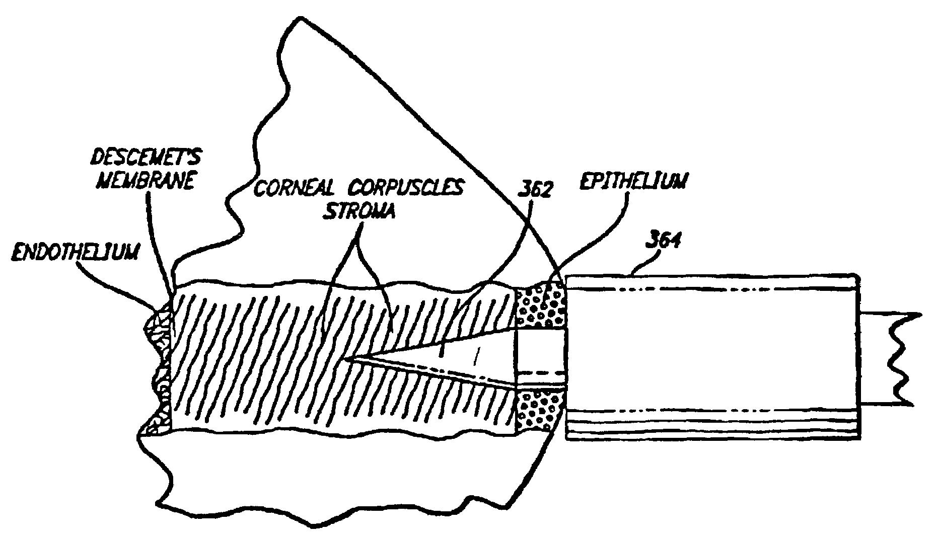 Method and apparatus for modifications of visual acuity by thermal means