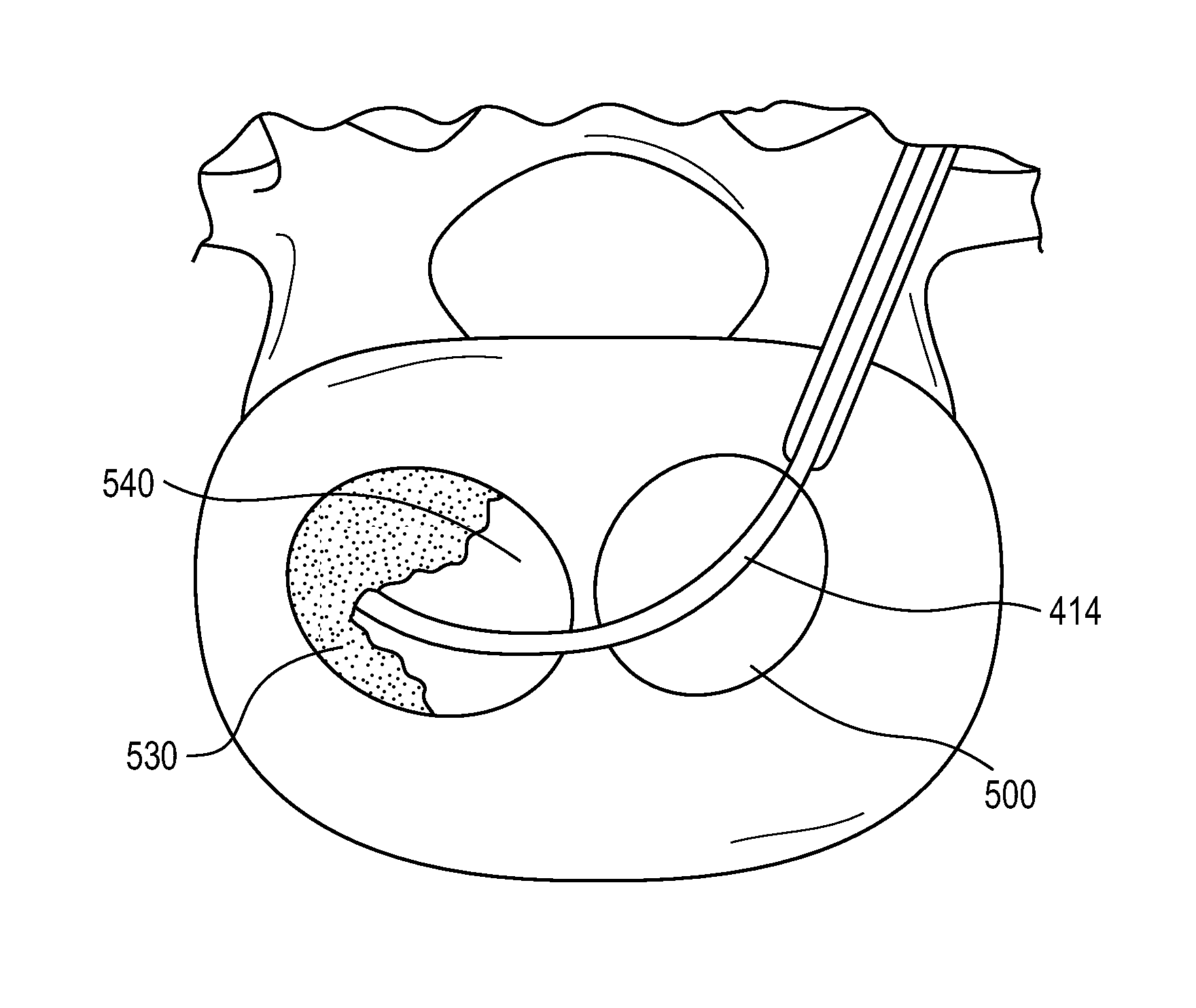 Method for balloon-aided vertebral augmentation