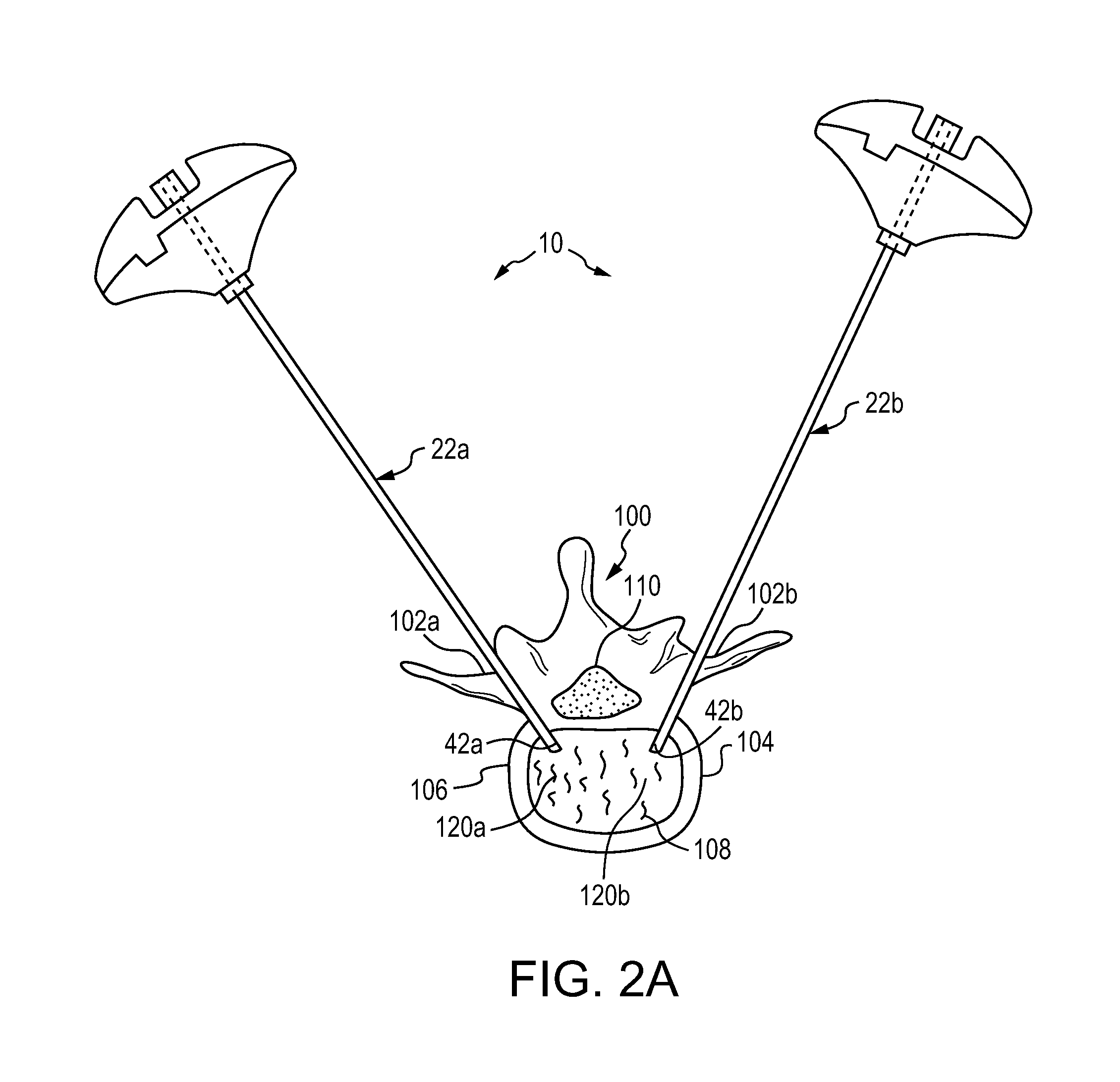 Method for balloon-aided vertebral augmentation