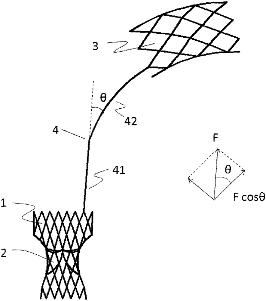 Pulmonary valve stent with anchor mechanism